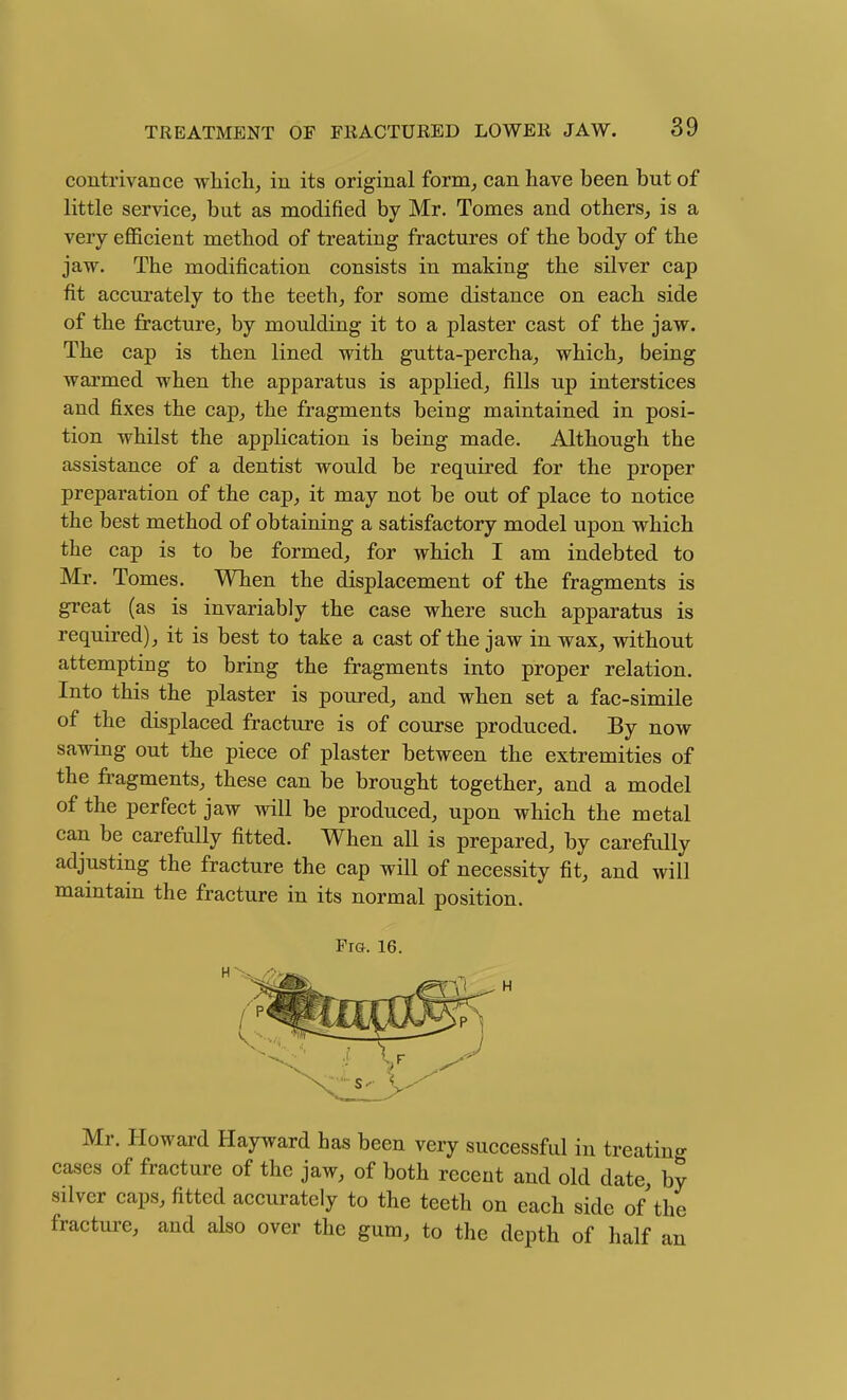 contrivance which, in its original form^ can have been but of little service, but as modified by Mr. Tomes and others, is a very efficient method of treating fractures of the body of the jaw. The modification consists in making the silver cap fit accurately to the teeth, for some distance on each side of the fracture, by moulding it to a plaster cast of the jaw. The cap is then lined with gutta-percha, which, being wai'med when the apparatus is applied, fills up interstices and fixes the cap, the fragments being maintained in posi- tion whilst the application is being made. Although the assistance of a dentist would be required for the proper preparation of the cap, it may not be out of place to notice the best method of obtaining a satisfactory model upon which the cap is to be formed, for which I am indebted to Mr. Tomes. When the displacement of the fragments is great (as is invariably the case where such apparatus is required), it is best to take a cast of the jaw in wax, without attempting to bring the fragments into proper relation. Into this the plaster is poured, and when set a fac-simile of the displaced fracture is of course produced. By now sawing out the piece of plaster between the extremities of the fragments, these can be brought together, and a model of the perfect jaw will be produced, upon which the metal can be carefully fitted. When all is prepared, by carefriUy adjusting the fracture the cap will of necessity fit, and will maintain the fracture in its normal position. Fig. 16. Mr. Howard Hayward has been very successful in treating cases of fracture of the jaw, of both recent and old date, by silver caps, fitted accurately to the teeth on each side of the fracture, and also over the gum, to the depth of half an