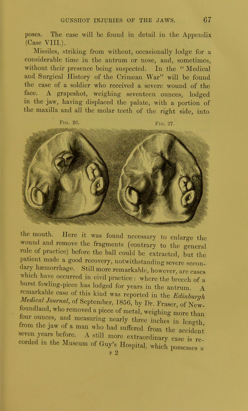 poses. The case will be found in detail in the Appendix (Case VIII.). Missiles, striking from without;, occasionally lodge for a considerable time in the antrum or nose, and, sometimes, without their presence being suspected. In the  Medical and Surgical History of the Crimean War will be found the case of a soldier who received a severe wound of the face. A grapeshot, weighing seventeen ounces, lodged in the jaw, having displaced the palate, with a portion of the maxilla and all the molar teeth of the right side, into Fig. 26, the mouth. Here it was found necessary to enlarge the wound and remove the fragments (contrary to the general rule of practice) before the ball could be extracted, but the patient made a good recovery, notwithstanding severe secon- dary hemorrhage. Still more remarkable, however, are cases which have occurred in civil practice : where the breech of a burst fowlmg-piece has lodged for years in the antrum. A remarkable case of this kind was reported in the Edinhurqh MedtcalJournal, of September, 1856, by Dr. Fraser, of New- foundland, who removed a piece of metal, weighing more than tour ounces, and measuring nearly three inches in length from the jaw of a man who had suffered from the accident seven years before. A still more extraordinary ease is re corded m the Museum of Guy's Hospital, which possesses t V 2