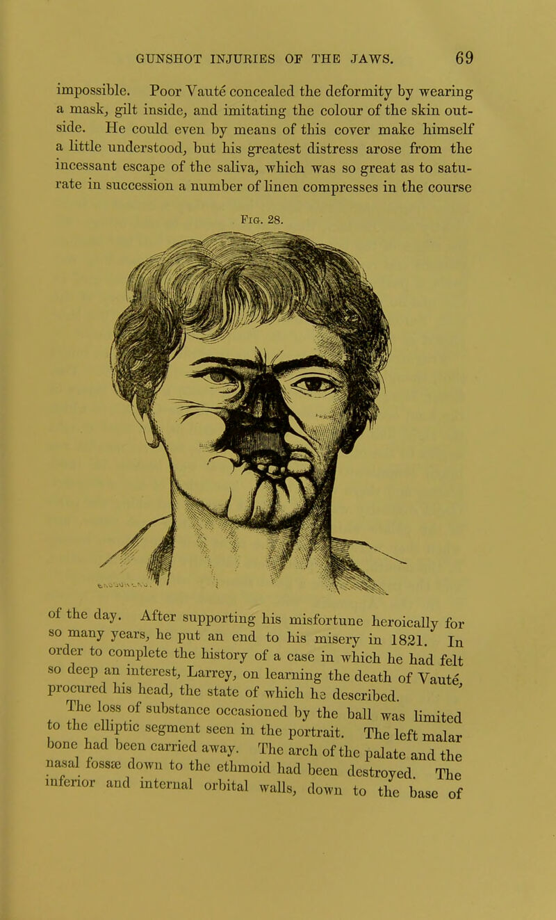 impossible. Poor Vaute concealed, the deformity by wearing a mask, gilt inside, and imitating the colour of the skin out- side. He could even by means of this cover make himself a little understood, but his greatest distress arose from the incessant escape of the saliva, which was so great as to satu- rate in succession a number of linen compresses in the course Fi&. 28. of the day. After supporting his misfortune heroically for so many years, he put an end to his misery in 1821 In order to complete the history of a case in which he had felt so deep an mterest, Larrey, on learning the death of Vaute procured his head, the state of which he described The loss of substance occasioned by the ball was limited to the elliptic segment seen in the portrait. The left malar bone had been carried away. The arch of the palate and the nasal fossee down to the ethmoid had been destroyed The mfenor and internal orbital walls, down to the base of
