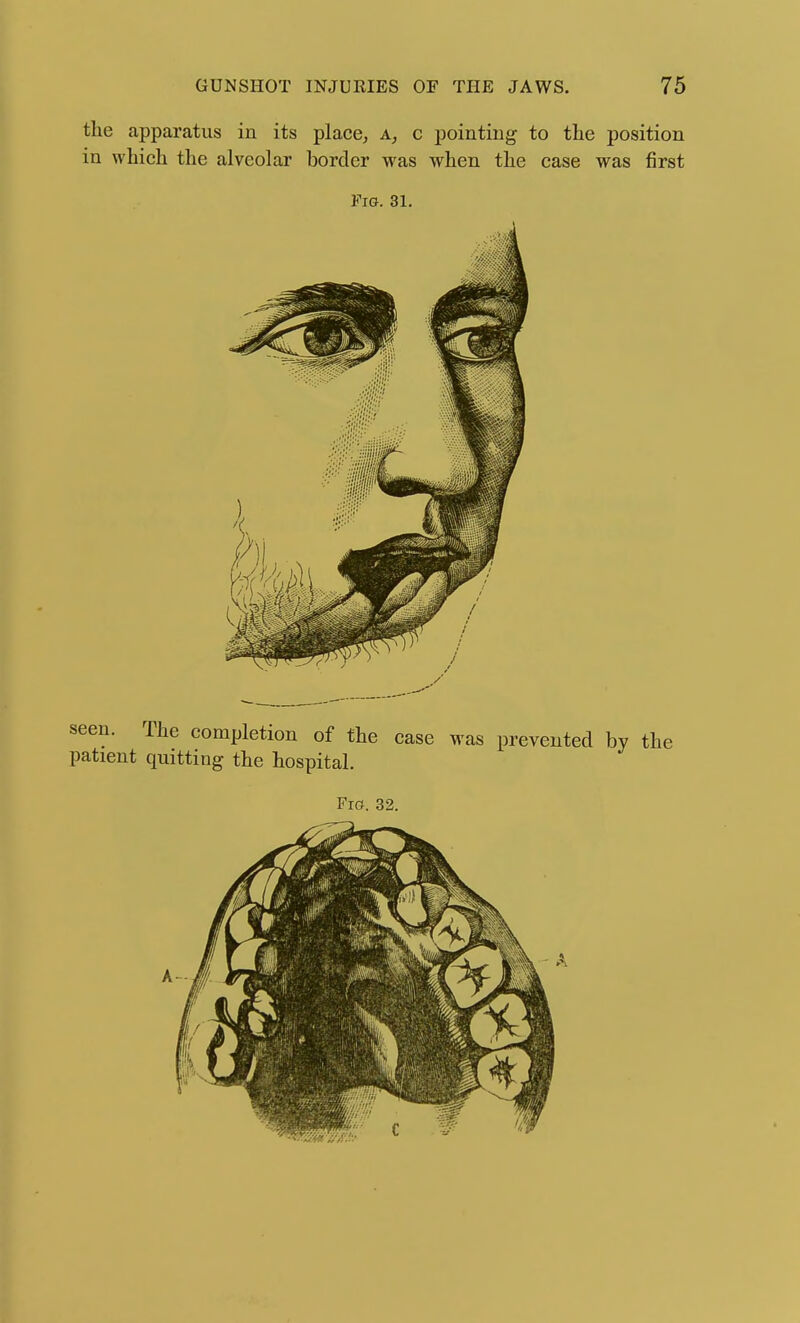 the apparatus in its place, a, c pointing to tLe position in which the alveolar border was when the case was first Fig. 31. seen. The completion of the case was prevented by the patient quitting the hospital. Fio. 32.