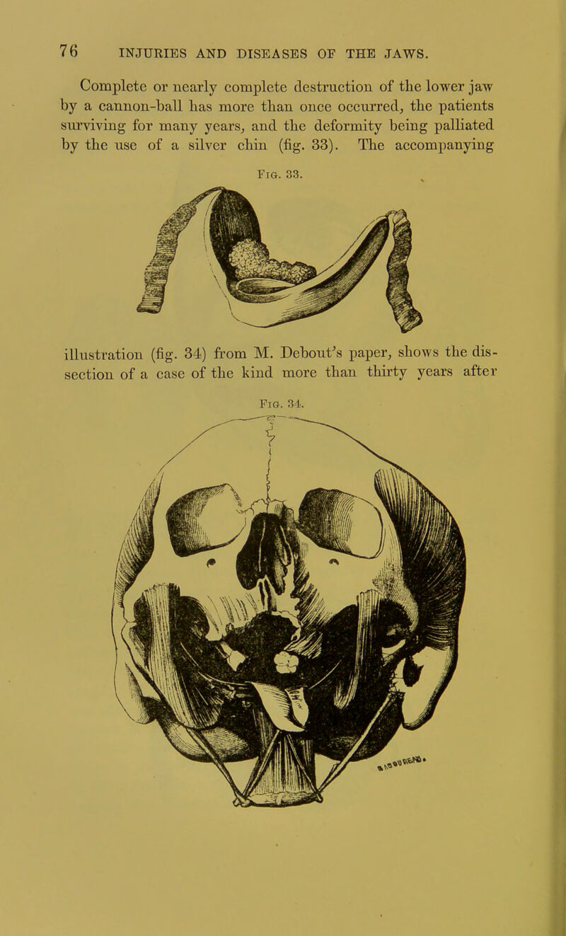 Complete or nearly complete destruction of the lower jaw by a cannon-ball has more than once occurred, the patients surviving for many years, and the deformity being palliated by the use of a silver chin (fig. 33). The accompanying Fig. 33. illustration (fig. 34) from M. Debout's paper, shows the dis- section of a case of the kind more than thirty years after