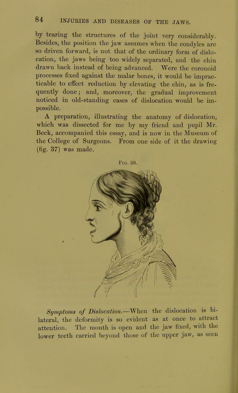 by tearing the structures of the joint very considerably. Besides^ the position the jaw assumes when the condyles are so driven forward, is not that of the ordinary form of dislo- cation, the jaws being too widely separated, and the chin drawn back instead of being advanced. Were the coronoid processes fixed against the malar bones, it would be imprac- ticable to effect reduction by elevating the chin, as is fre- quently done; and, moreover, the gradual improvement noticed in old-standing cases of dislocation would be im- possible, A preparation, illustrating the anatomy of dislocation, which was dissected for me by my friend and pupil Mr. Beck, accompanied this essay, and is now in the Museum of the College of Surgeons. From one side of it the drawing (fig. 37) was made. Fi&. 38. Symptoms of Dislocation.—When the dislocation is bi- lateral, the deformity is so evident as at once to attract attention. The mouth is open and the jaw fixed, with the lower teeth carried beyond those of the upper jaw, as seen