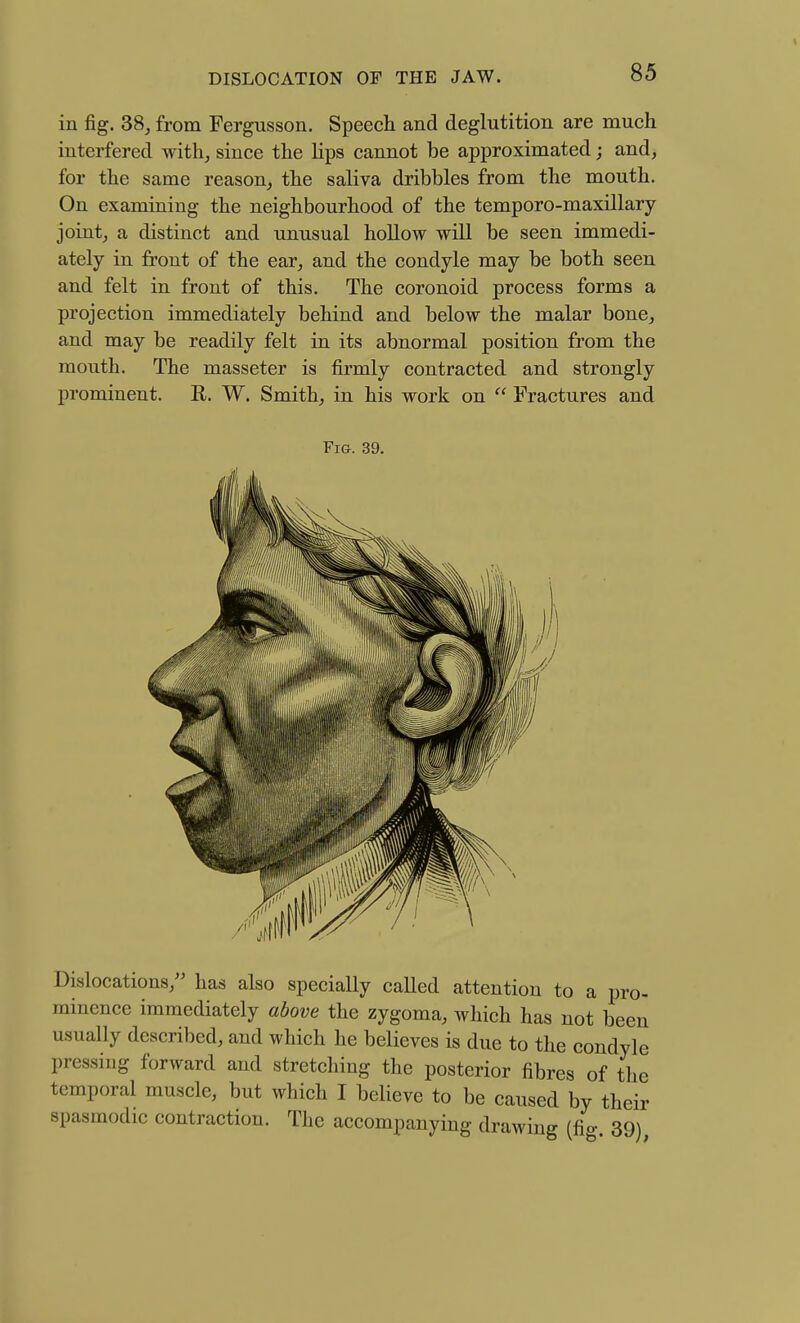 in fig. 38, from Fergusson. Speech and deglutition are much interfered with, since the hps cannot be approximated; and, for the same reason, the saliva dribbles from the mouth. On examining the neighbourhood of the temporo-maxillary joint, a distinct and unusual hollow will be seen immedi- ately in front of the ear, and the condyle may be both seen and felt in front of this. The coronoid process forms a projection immediately behind and below the malar bone, and may be readily felt in its abnormal position from the mouth. The masseter is firmly contracted and strongly prominent. E. W. Smith, in his work on  Fractures and ri&. 39, Dislocations, has also specially called attention to a pro- minence immediately above the zygoma, which has not been usually described, and which he believes is due to the condyle pressing forward and stretching the posterior fibres of the temporal muscle, but which I believe to be caused by their spasmodic contraction. The accompanying drawing (fig 39)
