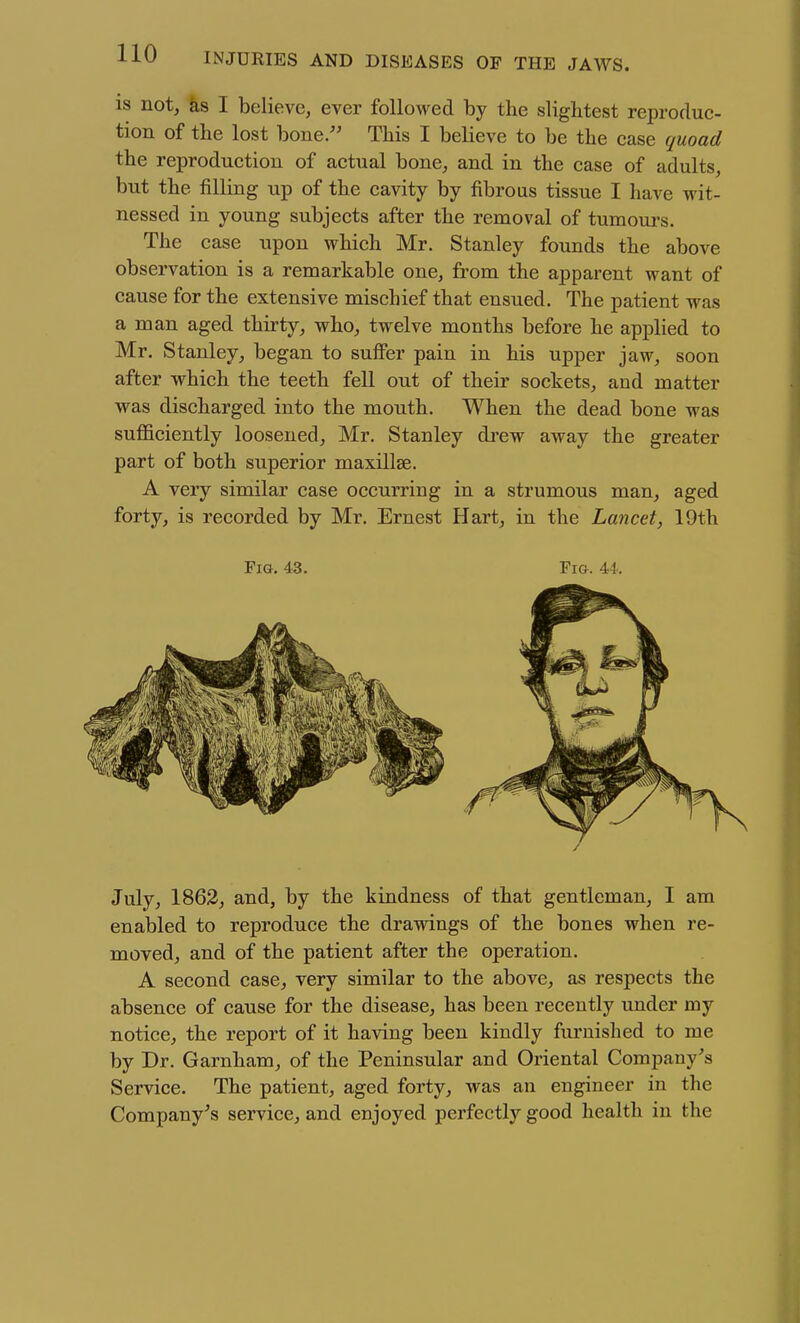 is not, ks I believe, ever followed by the slightest reproduc- tion of the lost bone. This I believe to be the case quoad the reproduction of actual bone, and in the case of adults, but the filling up of the cavity by fibrous tissue I have wit- nessed in young subjects after the removal of tumours. The case upon which Mr. Stanley founds the above observation is a remarkable one, from the apparent want of cause for the extensive mischief that ensued. The patient was a man aged thirty, who, twelve months before he applied to Mr. Stanley, began to suffer pain in his upper jaw, soon after which the teeth fell out of their sockets, and matter was discharged into the mouth. When the dead bone was sufficiently loosened, Mr. Stanley di'cw away the greater part of both superior maxillae. A very similar case occurring in a strumous man, aged forty, is recorded by Mr. Ernest Hart, in the Lancet, 19th July, 1862, and, by the kindness of that gentleman, I am enabled to reproduce the drawings of the bones when re- moved, and of the patient after the operation. A second case, very similar to the above, as respects the absence of cause for the disease, has been recently under my notice, the report of it having been kindly furnished to me by Dr. Garnham, of the Peninsular and Oriental Company's Service. The patient, aged forty, was an engineer in the Company^s service, and enjoyed perfectly good health in the