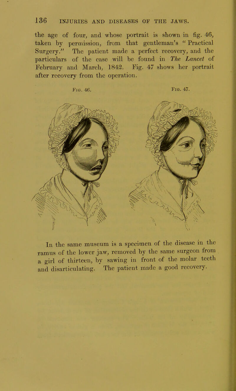 the age of four, and whose portrait is shown in fig. 46, taken by permission, from that gentleman's  Practical Surgery/' The patient made a perfect recovery, and the particulars of the case will be found in The Lancet of February and March, 1842. Fig. 47 shows her portrait after recovery from the operation. Fig. 46. Fig. 47. In the same museum is a specimen of the disease in the ramus of the lower jaw, removed by the same surgeon from a girl of thirteen, by sawing in front of the molar teeth and disarticulating. The patient made a good recovery.