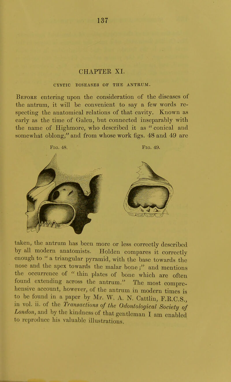 CHAPTER XI. CYSTIC DISEASES OF THE ANTRUM. Before entering upon the consideration of the diseases of the antrum, it will be convenient to say a few words re- specting the anatomical relations of that cavity. Known as early as the time of Galen, but connected inseparably with the name of Highmore, who described it as  conical and somewhat oblong/^ and from whose work figs. 48 and 49 are Fia. 48. Fm. 49. taken, the antrum has been more or less correctly described by all modern anatomists. Holden compares it correctly enough to  a triangular pyramid, with the base towards the nose and the apex towards the malar bone and mentions the occurrence of thin plates of bone which are often found extending across the antrum. The most compre- hensive account, however, of the antrum in modern times is to be found in a paper by Mr. W. A. N. Cattliu, F.R.C.S., in vol. ii. of the Transactions of the Odontological Society of London, and by the kindness of that gentleman I am enabled to reproduce his valuable illustrations.