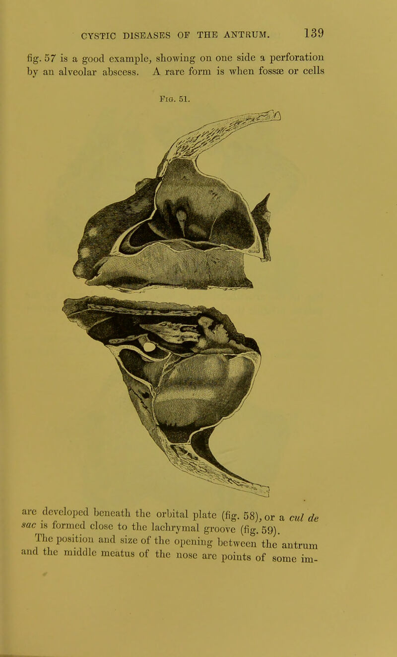 fig. 57 is a good example, showing on one side a perforation by an alveolar abscess. A rare form is wben fossae or cells Fig. 51. are developed beneath the orbital plate (fig. 58), or a cul de sac is formed close to the lachrymal groove (fig. 59) The position and size of the opening between the'antrum and the middle meatus of the nose are points of some im-