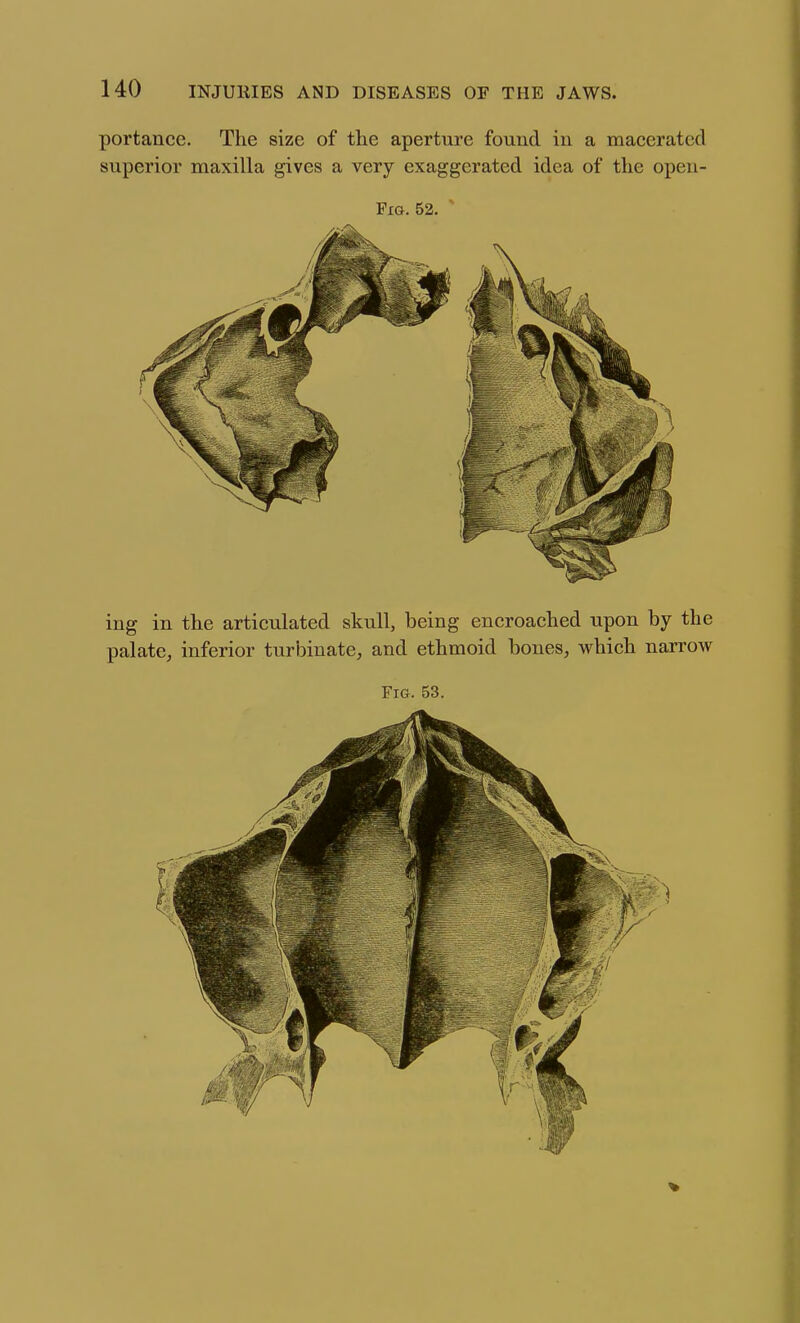 portance. The size of the aperture found iu a macerated superior maxilla gives a very exaggerated idea of the opeii- Fia. 52. ' ing in the articulated skull, being encroached upon by the palate, inferior turbinate, and ethmoid bones, which narrow