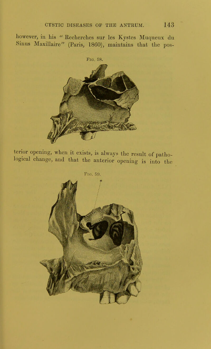 however, in his  Kecherches sur les Kystes Muqueux du Sinus Maxillaire'' (Paris, I860), maintains that the pos- FiG. 58, terior opening, when it exists, is always the result of patho- logical change, and that the anterior opening is into the