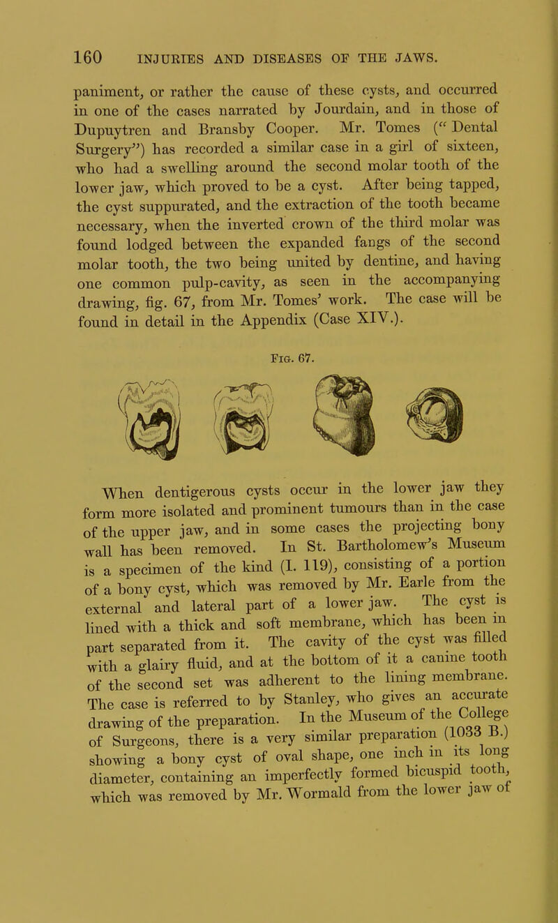 paniment, or rather the cause of these cysts, and occurred in one of the cases narrated by Jourdain, and in those of Dupuytren and Bransby Cooper. Mr. Tomes ( Dental Surgery'^) has recorded a similar case in a girl of sixteen, who had a swelling around the second molar tooth of the lower jaw, which proved to be a cyst. After being tapped, the cyst suppurated, and the extraction of the tooth became necessary, when the inverted crown of the third molar was found lodged between the expanded fangs of the second molar tooth, the two being united by dentine, and having one common pulp-cavity, as seen in the accompanying drawing, fig. 67, from Mr. Tomes' work. The case will be found in detail in the Appendix (Case XIV.). Fig. 67. When dentigerous cysts occur in the lower jaw they form more isolated and prominent tumours than in the case of the upper jaw, and in some cases the projecting bony wall has been removed. In St. Bartholomew's Museum is a specimen of the kind (1. 119), consisting of a portion of a bony cyst, which was removed by Mr. Earle from the external and lateral part of a lower jaw. The cyst is lined with a thick and soft membrane, which has been m part separated from it. The cavity of the cyst was fiUed with a glairy fluid, and at the bottom of it a canine tooth of the second set was adherent to the lining membrane. The case is referred to by Stanley, who gives an accurate drawing of the preparation. In the Museum of the College of Surgeons, there is a very similar preparation [1066 H.) showing a bony cyst of oval shape, one mch m its long diameter, containing an imperfectly formed bicuspid tooth which was removed by Mr. Wormald from the lower jaw ot