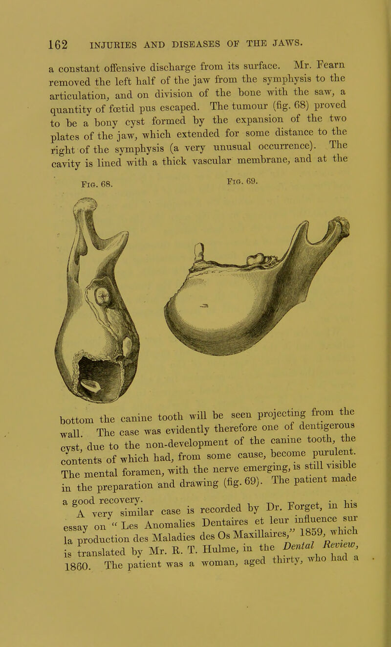 a constant offensive discharge from its surface. Mr. Fearn removed the left half of the jaw from the symphysis to the ai'ticulation, and on division of the bone with the saw, a quantity of foetid pus escaped. The tumour (fig. 68) proved to he a bony cyst formed by the expansion of the two plates of the jaw, which extended for some distance to the right of the symphysis (a very unusual occurrence). The cavity is lined with a thick vascular membrane, and at the Fia. 68. Fig. 69. bottom the canme tooth will be seen projectmg from the wall. The ease was evidently therefore one of dentigerons cyst, due to the non-development of the eanme tooth the contents of whieh had, from some eause. 1-™ The mental foramen, with the nerve emergmg, is still visible I trpreparation and drawing (fig. 69). The patient made ^ TteTIi^ilar ease is recorded by Dr. Forge, in bis essay on  Les Anomalies Dentaii-es et mfaence sn. Tproduction des Maladies des Os MaxiUaires, 1859, whieh 1: translated by Mr. R. T. Hulme, in the Z)«^«/ I860. The patient was a woman, aged thirty, who haa a