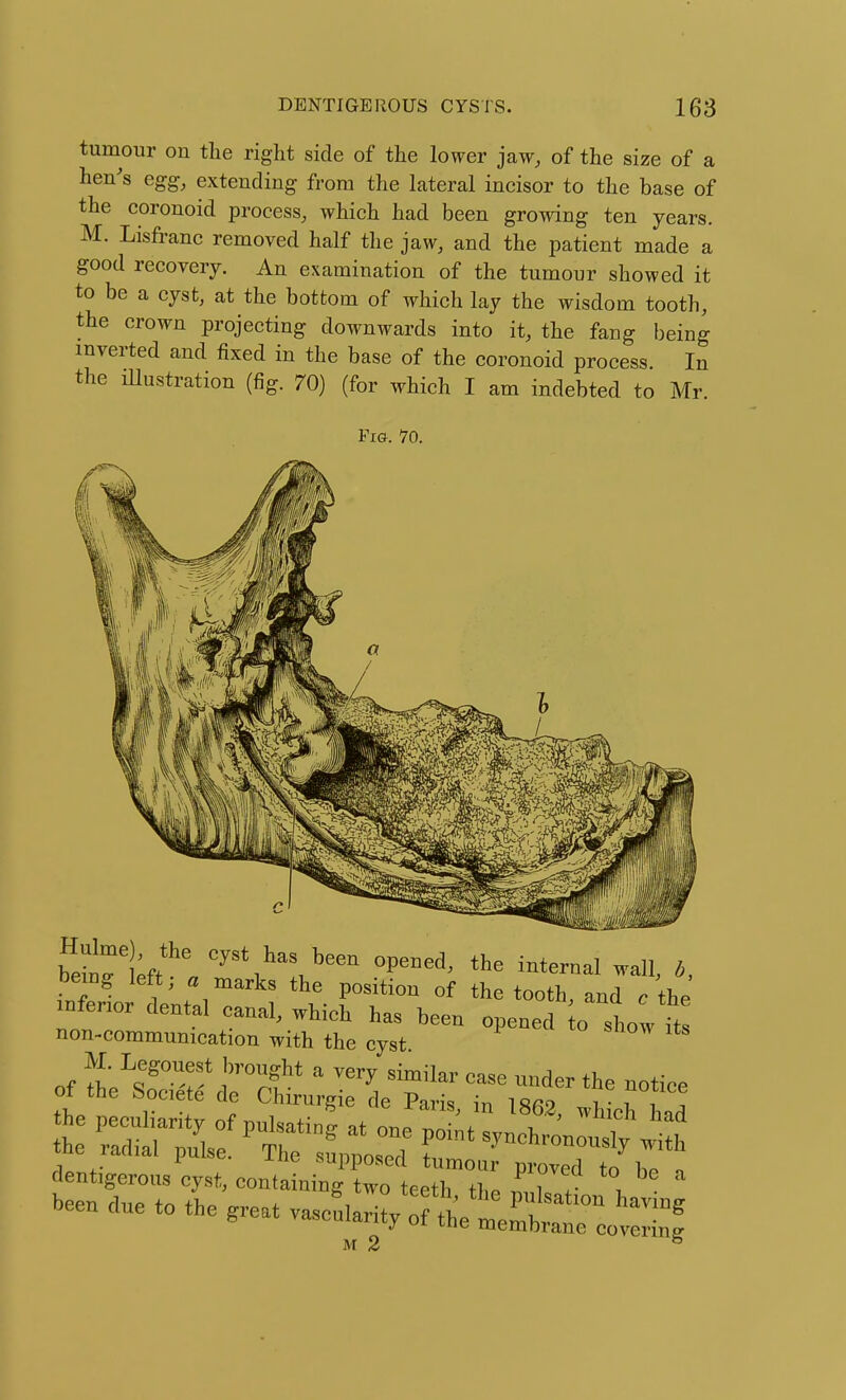 tumour on the right side of the lower jcaw, of the size of a hen's egg, extending from the lateral incisor to the base of the coronoid process, which had been growing ten years. M. Lisfranc removed half the jaw, and the patient made a good recovery. An examination of the tumour showed it to be a cyst, at the bottom of which lay the wisdom tooth, the crown projecting downwards into it, the fang being inverted and fixed in the base of the coronoid process. In the illustration (fig. 70) (for which I am indebted to Mr Fig. 70. bang left; o marks the position of the tooth, and c the mfenor dental canal, which has been opened o show L non-communication with the cyst M 2 ^