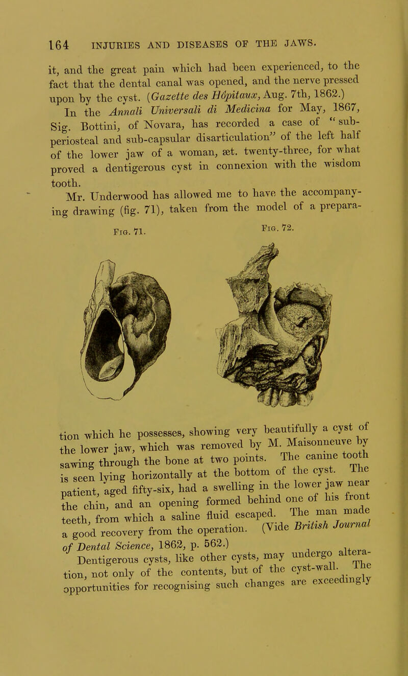 it, and the great pain which had heen experienced, to the fact that the dental canal was opened, and the nerve pressed upon by the cyst. [Gazette des HSpitavx, Aug. 7th, 1863.) In the Annali Universali di Medicina for May, 1867, Sig. Bottini, of Novara, has recorded a case of  sub- periosteal and sub-capsular disarticulation of the left half of the lower jaw of a woman, set. twenty-three, for what proved a dentigerous cyst in connexion with the wisdom tooth. Mr. Underwood has allowed me to have the accompany- ing drawing (fig. 71), taken from the model of a prepara- FiG. 71. Fig. 72. tion which he possesses, showing very beautifully a cyst of the lower jaw, which was removed by ^^^—^^^ sawing through the bone at two pomts. The canme tooth s™n lying horizontally at the bottom of the cyst. The uatTent Led fifty-six, had a swelHng in the lower jaw near Cchin and al opening formed behind one of h.s fron eeth from which a saline fluid escaped. The man made a gtd recovery from the operation. (Vide Bnt^sh Journal of Dental Science, 1863, p. 562.) Dentigerous cysts, like other cysts, may undergo alteia- tion, not only of the contents, but of the cyst-wall. Lhe opportunities for recognising such changes are exceedmgly