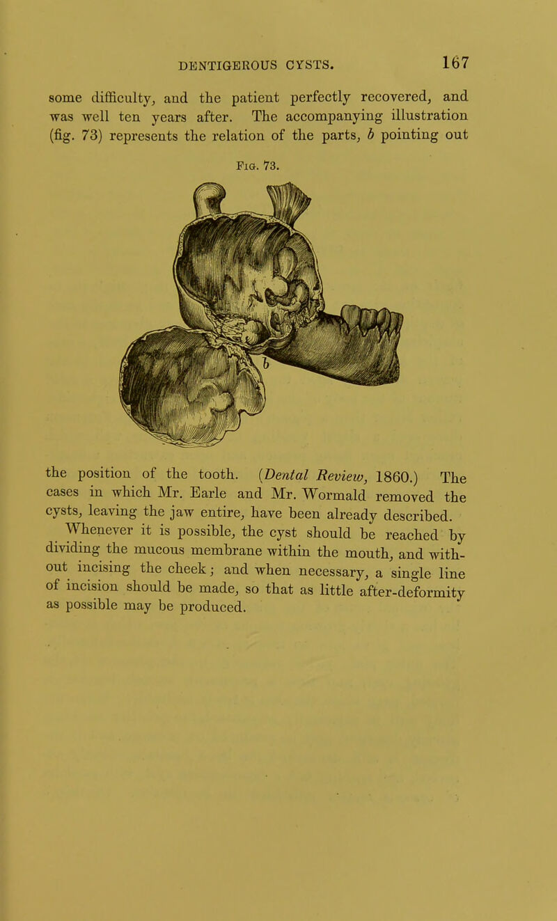 some difficulty^ and the patient perfectly recovered, and was well ten years after. The accompanying illustration (fig. 73) represents the relation of the parts, b pointing out Pia. 73. the position of the tooth. {Dental Review, 1860.) The cases in which Mr. Earle and Mr. Wormald removed the cysts, leaving the jaw entire, have been already described. Whenever it is possible, the cyst should be reached by dividing the mucous membrane within the mouth, and with- out incising the cheek; and when necessary, a single line of incision should be made, so that as little after-deformity as possible may be produced.