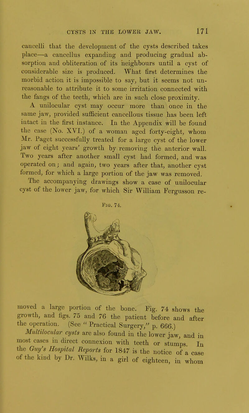 caucelli that tlie development of the cysts described takes place—a cancellus expanding and producing gradual ab- sorption and obliteration of its neighbours until a cyst of considerable size is produced. What first determines the morbid action it is impossible to say, but it seems not un- reasonable to attribute it to some irritation connected with the fangs of the teeth_, which are in such close proximity. A unilocular cyst may occur more than once in the same jaw, provided sufficient cancellous tissue has been left intact in the first instance. In the Appendix will be found the case (No. XVI.) of a woman aged forty-eight, whom Mr. Paget successfully treated for a large cyst of the lower jaw of eight years^ growth by removing the anterior wall. Two years after another small cyst had formed, and was operated on; and again, two years after that, another cyst formed, for which a large portion of the jaw was removed. The accompanying drawings show a case of unilocular cyst of the lower jaw, for which Sir William Fergusson re- PiG. 74. moved a large portion of the bone. Fig. 74> shows the growth, and figs. 75 and 76 the patient before and after the operation. (See  Practical Surgery,^' p. 666.) MuUilocular cijsts are also found in the lower jaw, and in most cases in direct connexion with teeth or stumps In the Guy's Hospital Reports for 1847 is the notice of a case of the kind by Dr. Wilks, in a girl of eighteen, in whom