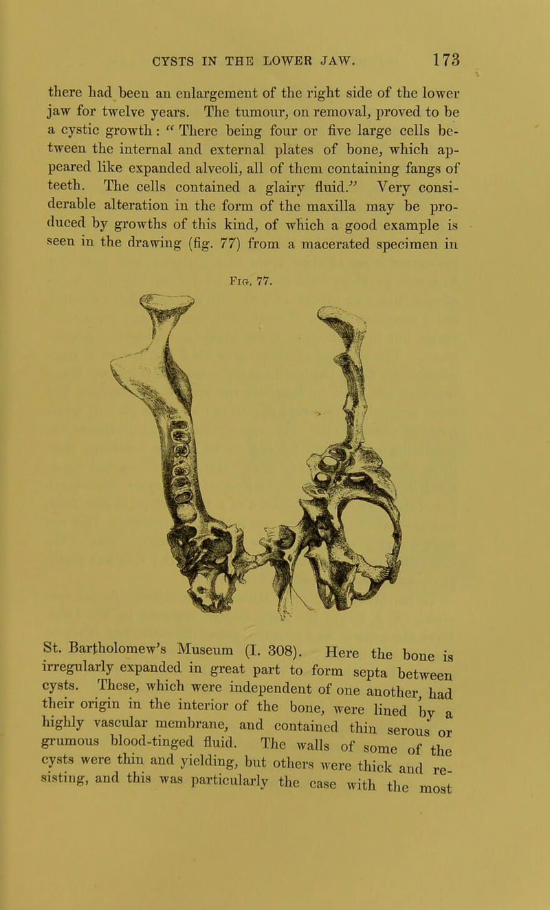 there had been an enlargement of the right side of the lower jaw for twelve years. The tumour, on removal, proved to be a cystic growth:  There being four or five large cells be- tween the internal and external plates of bone, which ap- peared like expanded alveoli, all of them containing fangs of teeth. The cells contained a glairy fluid/^ Very consi- derable alteration in the form of the maxilla may be pro- duced by growths of this kind, of which a good example is seen in the drawing (fig. 77) from a macerated specimen in St. Bartholomew's Museum (I. 308). Here the bone is irregularly expanded in great part to form septa between cysts. These, which were independent of one another had their origin in the interior of the bone, were lined by a highly vascular membrane, and contained thin serous or grumous blood-tinged fluid. The walls of some of the cysts were thin and yielding, but others were thick and re sisting, and this was particularly the case with the most
