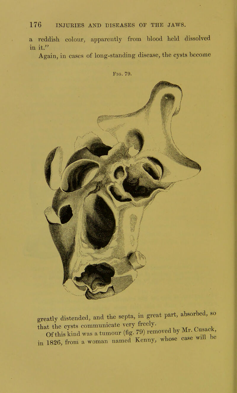 a reddish, colour, apparently from blood held dissolved in it. Again, in cases of long-standing disease, the cysts become Fig. 79. greatly distended, and the septa, in gi'cat part, absorbed, so that the cysts communicate very freely. Of this land was a tumour (fig. 79) removed by Mr. Cu ack in 1826, from a woman named Kenny, whose case will be