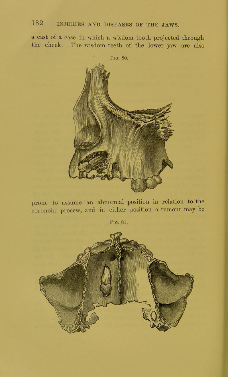 a cast of a case in which a wisdom tooth projected through the cheek. The wisdom teeth of the lower jaw are also Fig. 80. prone to assume an abnormal position in relation to the coronoid process, and in either position a tumour may be Fig. 81.