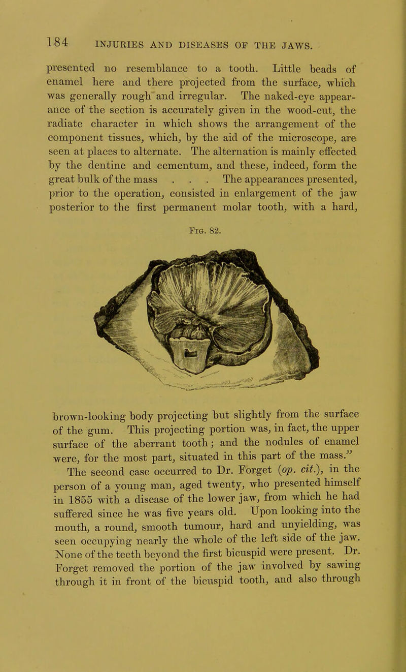presented no resemblance to a tooth. Little beads of enamel here and there projected from the surface^ which was generally rough and irregular. The naked-eye appear- ance of the section is accurately given in the wood-cut, the radiate character in which shows the arrangement of the component tissues^ which, by the aid of the microscope^ are seen at places to alternate. The alternation is mainly effected by the dentine and cementum, and these, indeed, form the great bulk of the mass . . . The appearances presented, prior to the operation, consisted in enlargement of the jaw posterior to the first permanent molar tooth, with a hard, Fi&. 82. brown-looking body projecting but slightly from the surface of the gum. This projecting portion was, in fact, the upper surface of the aberrant tooth j and the nodules of enamel were, for the most part, situated in this part of the mass.'' The second case occurred to Dr. Forget {op. cit.), in the person of a young man, aged twenty, who presented himself in 1855 with a disease of the lower jaw, from which he had suffered since he was five years old. Upon looking into the mouth, a round, smooth tumour, hard and unyielding, was seen occupying nearly the whole of the left side of the jaw. None of the teeth beyond the first bicuspid were present. Dr. Forget removed the portion of the jaw involved by sawing through it in front of the bicuspid tooth, and also through