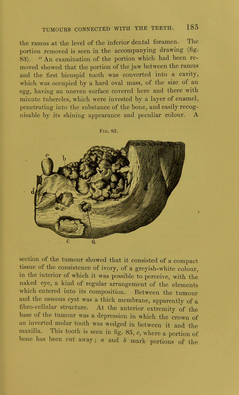 the ramus .at the level of the inferior dental foramen. The portion removed is seen in the accompanying drawing (fig. 83). ''An examination of the portion which had been re- moved showed that the portion of the jaw between the ramus and the first bicuspid tooth was converted into a cavity, which was occupied by a hard oval mass, of the size of an egg, having an uneven surface covered here and there with minute tubercles, which were invested by a layer of enamel, penetrating into the substance of the bone, and easily recog- nisable by its shining appearance and peculiar colour. A Fi&. 83. section of the tumour showed that it consisted of a compact tissue of the consistence of ivory, of a greyish-white colour, in the interior of which it was possible to perceive, with the naked eye, a kind of regular arrangement of the elements which entered into its composition. Between the tumour and the osseous cyst was a thick membrane, apparently of a fibro-cellular structure. At the anterior extremity of the base of the tumour was a depression in which the crown of an inverted molar tooth was wedged in between it and the maxilla. This tooth is seen in fig. 83, c, where a portion of bone has been cut away; a and b mark portions of the