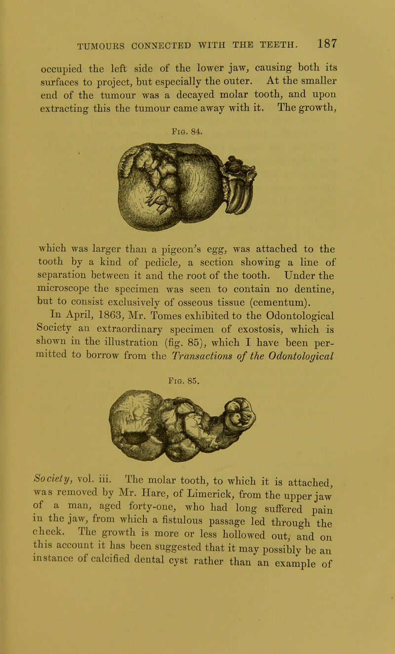 occupied the left side of the lower jaw, causing both its surfaces to project, but especially the outer. At the smaller end of the tumour was a decayed molar tooth, and upon extracting this the tumour came away with it. The growth, Fig. 84. which was larger than a j)igeon's egg, was attached to the tooth by a kind of pedicle, a section showing a line of separation between it and the root of the tooth. Under the microscope the specimen was seen to contain no dentine, but to consist exclusively of osseous tissue (cementum). In April, 1863, Mr. Tomes exhibited to the Odontological Society an extraordinary specimen of exostosis, which is shown in the illustration (fig. 85), which I have been per- mitted to borrow from the Transactions of the Odontological Fm. 85. Society, vol. iii. The molar tooth, to which it is attached, was removed by Mr. Hare, of Limerick, from the upper jaw of a man, aged forty-one, who had long suffered pain in the jaw, from which a fistulous passage led through the cheek. The growth is more or less hollowed out,- and on this account it has been suggested that it may possibly be an mstance of calcified dental cyst rather than an example of
