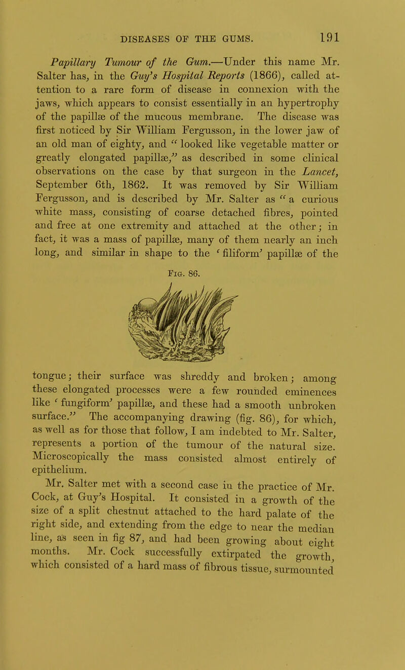Papillary Tumour of the Gum.—Under this name Mr, Salter has^ in the Guy's Hospital Reports (1866), called at- tention to a rare form of disease in connexion with the jawSj which appears to consist essentially in an hypertrophy of the papillae of the mucous membrane. The disease was first noticed by Sir William Fergusson, in the lower jaw of an old man of eighty, and looked like vegetable matter or greatly elongated papillae/^ as described in some clinical observations on the case by that surgeon in the Lancet, September 6th_, 1863. It was removed by Sir William Fergusson, and is described by Mr. Salter as  a curious white mass, consisting of coarse detached fibres, pointed and free at one extremity and attached at the other; in fact, it was a mass of papillae, many of them nearly an inch long, and similar in shape to the ^ filiform papillae of the Fig. 86. tongue; their surface was shreddy and broken; among these elongated processes were a few rounded eminences like ' fungiform' papillae, and these had a smooth unbroken surface.'' The accompanying drawing (fig. 86), for which, as well as for those that follow, I am indebted to Mr. Salter, represents a portion of the tumour of the natural size. Microscopically the mass consisted almost entirely of epithelium. Mr. Salter met with a second case in the practice of Mr. Cock, at Guy's Hospital. It consisted in a growth of the size of a split chestnut attached to the hard palate of the right side, and extending from the edge to near the median line, as seen in fig 87, and had been growing about eight months. Mr. Cock successfully extirpated the grow^th which consisted of a hard mass of fibrous tissue, surmounted