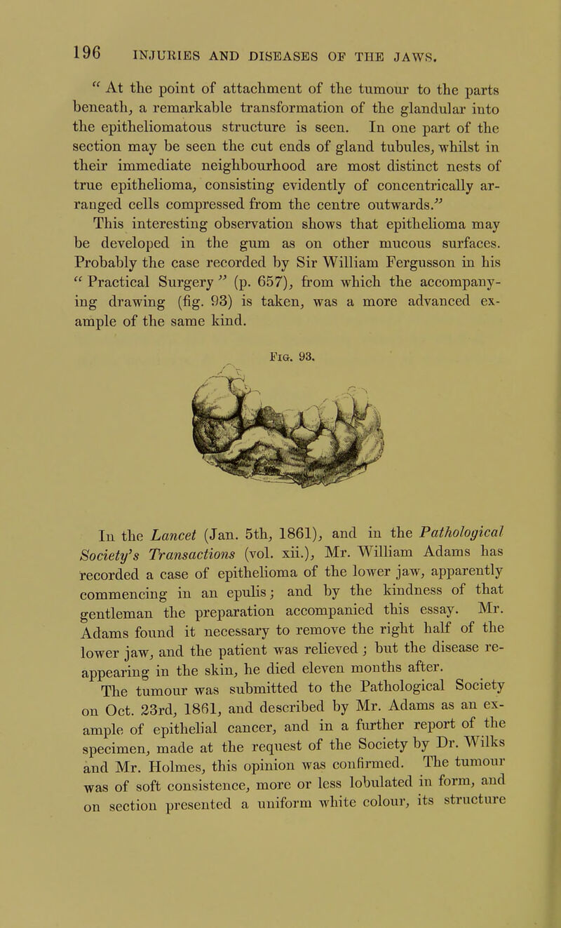  At the point of attachment of the tumour to the parts beneath, a remarkable transformation of the glandular into the epitheliomatous structure is seen. In one part of the section may be seen the cut ends of gland tubules, whilst in their immediate neighbourhood are most distinct nests of true epithelioma, consisting evidently of concentrically ar- ranged cells compressed from the centre outwards/^ This interesting observation shows that epithelioma may be developed in the gum as on other mucous surfaces. Probably the case recorded by Sir William Fergusson in his  Practical Surgery  (p. 657), from which the accompany- ing drawing (fig. 93) is taken, was a more advanced ex- ample of the same kind. J?i&. 93. In the Lancet (Jan. 5th, 1861), and in the Pathological Society's Transactions (vol. xii.), Mr. William Adams has recorded a case of epithelioma of the lower jaw, apparently commencing in an epulis; and by the kindness of that gentleman the preparation accompanied this essay. Mr. Adams found it necessary to remove the right half of the lower jaw, and the patient was relieved; but the disease re- appearing in the skin, he died eleven months after. The tumour was submitted to the Pathological Society on Oct. 23rd, 1861, and described by Mr. Adams as an ex- ample of epithelial cancer, and in a further report of the specimen, made at the request of the Society by Dr. Wilks and Mr. Holmes, this opinion was confirmed. The tumour was of soft consistence, more or less lobulated in form, and on section presented a uniform white colour, its structure