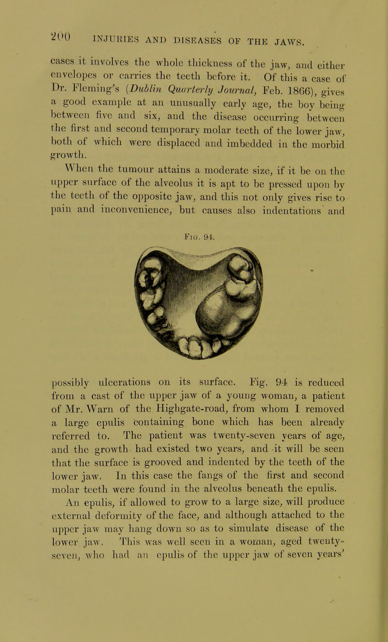 cases it involves the whole thickness of the jaw, and either envelopes or carries the teeth before it. Of this a case of Dr. Fleming's [Dublin Quarterly Journal, Feb. 1866), gives a good example at an unusually early age, the boy being between five and six, and the disease occurring between the first and second temporary molar teeth of the lower jaw, both of which were displaced and imbedded in the morbid growth. When the tumour attains a moderate size, if it be on the upper surface of the alveolus it is apt to be pressed upon by the teeth of the opposite jaw, and this not only gives rise to pain and inconvenience, but causes also indentations and Fig. 94. possibly ulcerations on its surface. Fig. 94 is reduced from a cast of the upper jaw of a young woman, a patient of Mr. Warn of the Highgate-road, from whom I removed a large epulis containing bone which has been already referred to. The patient was twenty-seven years of age, and the growth had existed two years, and it will be seen that the surface is grooved and indented by the teeth of the lower jaw. In this case the fangs of the first and second molar teeth were found in the alveolus beneath the epulis. An epulis, if allowed to grow to a large size, will produce external deformity of the face, and although attached to the upper jaw may hang down so as to simulate disease of the lower jaw. This was well seen in a woman, aged twenty- seven, who hud an epulis of the upper jaw of seven years'