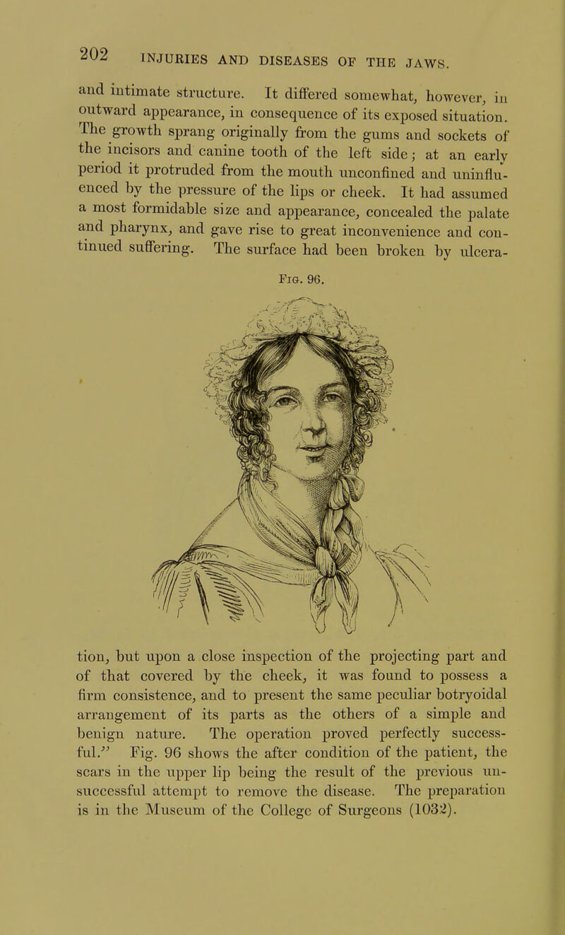 and intimate structure. It differed somewhat, however, iu outward appearance, in consequence of its exposed situation. The growth sprang originally from the gums and sockets of the incisors and canine tooth of the left side; at an early period it protruded from the mouth unconfined and uninflu- enced by the pressure of the lips or cheek. It had assumed a most formidable size and appearance, concealed the palate and pharynx, and gave rise to great inconvenience and con- tinued suffering. The surface had been broken by ulcera- Fia. 96. tion, but upon a close inspection of the projecting part and of that covered by the cheek, it was found to possess a firm consistence, and to present the same peculiar botryoidal arrangement of its parts as the others of a simple and benign nature. The operation proved perfectly success- ful.'^ Fig. 96 shows the after condition of the patient, the scars in the upper lip being the result of the prcAdous un- successful attempt to remove the disease. The preparation is in the Museum of the College of Surgeons (1032).