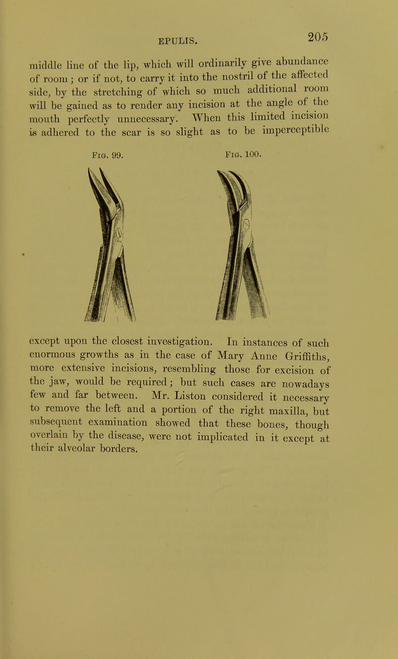 middle line of the lip, which will ordinarily give abundance of room ; or if not, to carry it into the nostril of the affected side, by the stretching of which so much additional room Avill be gained as to render any incision at the angle of the mouth perfectly unnecessary. When this limited incision i£ adhered to the scar is so slight as to be imperceptible Fia. 99. Fig. 100. except upon the closest investigation. In instances of such enormous growths as in the case of Mary Anne Griffiths, more extensive incisions, resembling those for excision of the jaw, would be required; but such cases are nowadays few and far between. Mr. Listen considered it necessary to remove the left and a portion of the right maxilla, but subsequent examination showed that these bones, though overlain by the disease, were not implicated in it except at their alveolar borders.