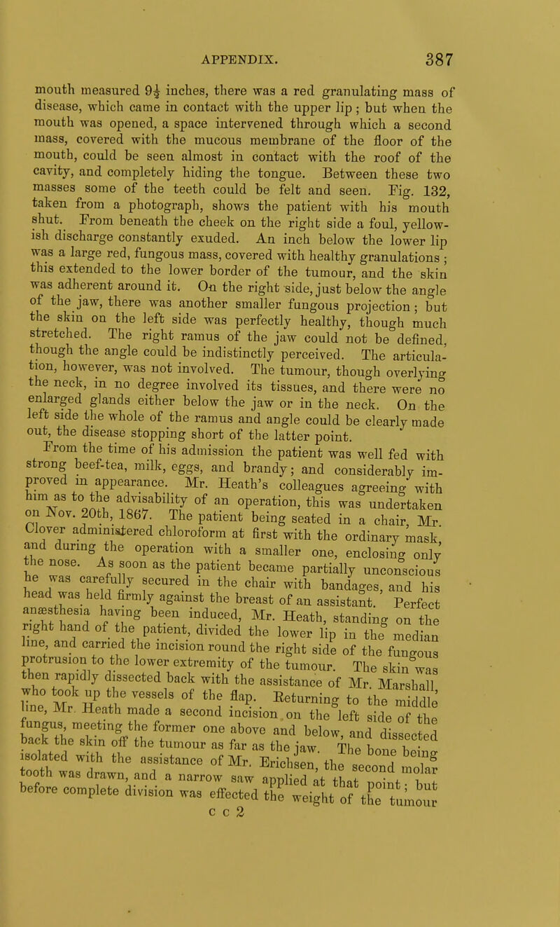 mouth measured 9^ inches, there was a red granulating mass of disease, which came in contact with the upper lip; but when the mouth was opened, a space intervened through which a second mass, covered with the mucous membrane of the floor of the mouth, could be seen almost in contact with the roof of the cavity, and completely hiding the tongue. Between these two masses some of the teeth could be felt and seen. Eig. 132, taken from a photograph, shows the patient with his mouth shut.^ Prom beneath the cheek on the right side a foul, yellow- ish discharge constantly exuded. An inch below the lower lip was a large red, fungous mass, covered with healthy granulations ; this extended to the lower border of the tumour, and the skin was adherent around it. On the right side, just below the angle of the jaw, there was another smaller fungous projection; but the skin on the left side was perfectly healthy, though much stretched. The right ramus of the jaw could not be defined, though the angle could be indistinctly perceived. The articula- tion, however, was not involved. The tumour, though overlying the neck, in no degree involved its tissues, and there were no enlarged glands either below the jaw or in the neck. On the left side tlie whole of the ramus and angle could be clearly made out, the disease stopping short of the latter point. From the time of his admission the patient was well fed with strong beef-tea, milk, eggs, and brandy; and considerably im- proved m appearance. Mr. Heath's colleagues agreeing with him as to the advisability of an operation, this was undertaken on JSTov. 20th, 1867. The patient being seated in a chair, Mr Clover administered chloroform at first with the ordinary mask' and during the operation with a smaller one, enclosing only the nose. As soon as the patient became partially unconscious lir' 'I'i l^ r'*^ '^'^ ^^^^ bandages, and his head was held firmly agamst the breast of an assistant. Perfect anaesthesia having been induced, Mr. Heath, standing on the right hand of the patient, divided the lower lip in the median Ime and carried the incision round the right side of the fungous protrusion to the lower extremity of the tumour. The skin was then rapidly dissected back with the assistance of Mr Marshall who took up the vessels of the flap. Eeturning to the m ddle line, Mr. Heath made a second iacision on the left side of the fungus meeting the former one above and below, and dissected back the skin ofi the tumour as far as the iaw The bmiP isolated with the assistance of Mr. Erichse^'thp L ,f tooth was drawn, and a narrow saw apptr^t that^ W before complete division was effected t^Xl-^K^of tC^^^^^^ c c 2
