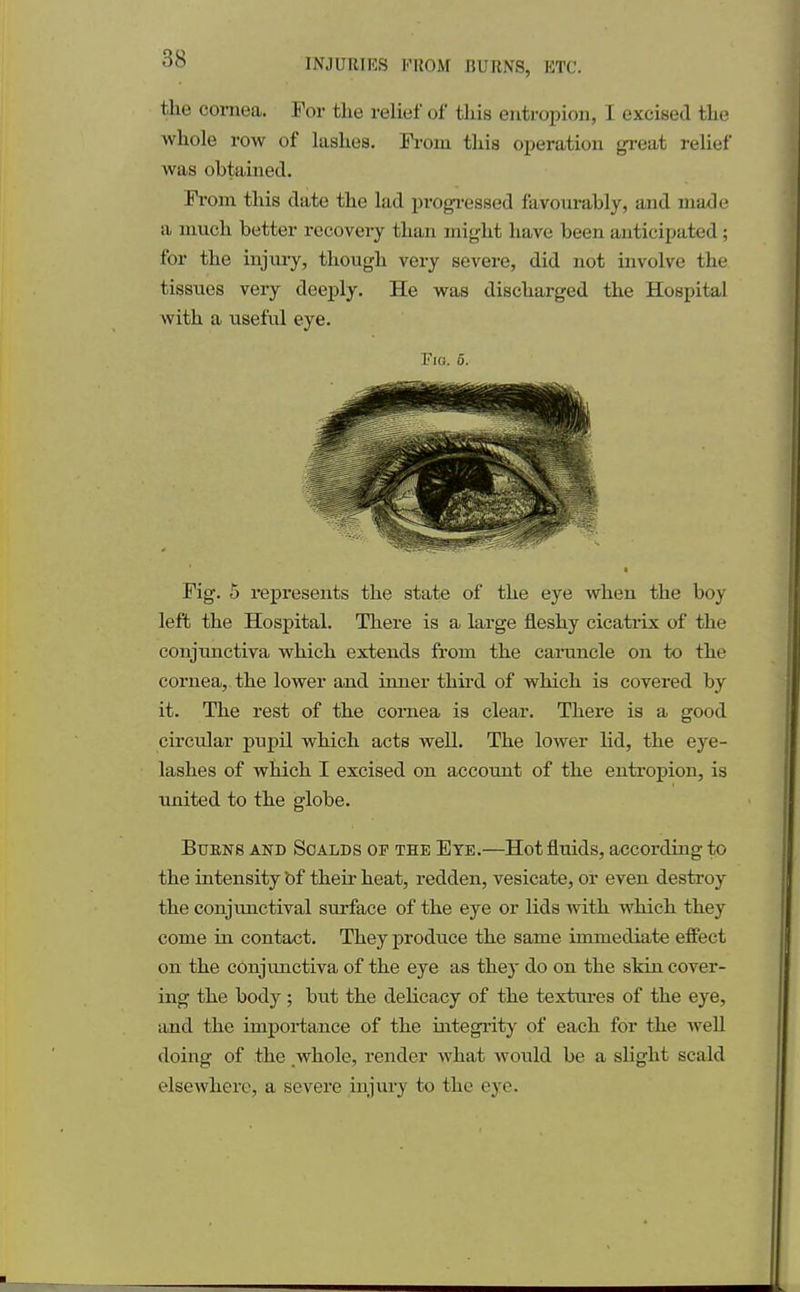 the cornea. For the relief of this entropion, I excised the whole row of lashes. From this operation great relief was obtained. From this date the lad progressed favourably, and made a much better recovery than might have been anticipated; for the injury, though very severe, did not involve the tissues very deeply. He was discharged the Hospital with a usefnl eye. Fm. 6. Fig. 5 represents the state of the eye when the boy left the Hospital. There is a large fleshy cicatrix of the conjunctiva which extends from the caruncle on to the cornea, the lower and inner third of which is covered by it. The rest of the cornea is clear. There is a good circular pupil which acts well. The lower lid, the eye- lashes of which I excised on account of the entropion, is united to the globe. Burns and Scalds of the Eye.—Hot fluids, according to the intensity Of their heat, redden, vesicate, or even destroy the conjunctival surface of the eye or lids with which they come in contact. They produce the same immediate effect on the conjunctiva of the eye as they do on the skin cover- ing the body; but the delicacy of the textures of the eye, and the importance of the integrity of each for the well doing of the whole, render what would be a slight scald elsewhere, a severe injury to the eye.