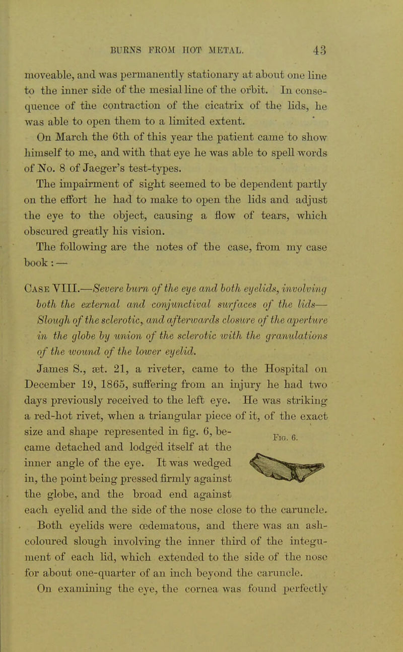 moveable, and was permanently stationary at about one line to the inner side of the mesial line of the orbit. In conse- quence of the contraction of the cicatrix of the lids, he was able to open them to a limited extent. On March the 6th of this year the patient came to show himself to me, and with that eye he was able to spell words of No. 8 of Jaeger's test-types. The impairment of sight seemed to be dependent partly on the effort he had to make to open the lids and adjust the eye to the object, causing a flow of tears, which obscured greatly his vision. The following are the notes of tbe case, from my case book: — Case VIII.—Severe burn of the eye and both eyelids, involving both the external and conjunctival surfaces of the lids— Slough of the sclerotic, and afterwards closure of the aperture in the globe by union of the sclerotic with the granulations of the wound of the lower eyelid. James S., set. 21, a riveter, came to the Hospital on December 19, 1865, suffering from an injury he had two days previously received to the left eye. He was striking a red-hot rivet, when a triangidar piece of it, of the exact size and shape represented in fig. 6, be- came detached and lodged itself at the inner angle of the eye. It was wedged in, the point being pressed firmly against the globe, and the broad end against each eyelid and the side of the nose close to the caruncle. Both eyelids were cedematous, and there was an ash- coloured slough involving the inner third of the integu- ment of each lid, which extended to the side of the nose for about one-quarter of an inch beyond the caruncle. On examining the eye, the cornea was found perfectly