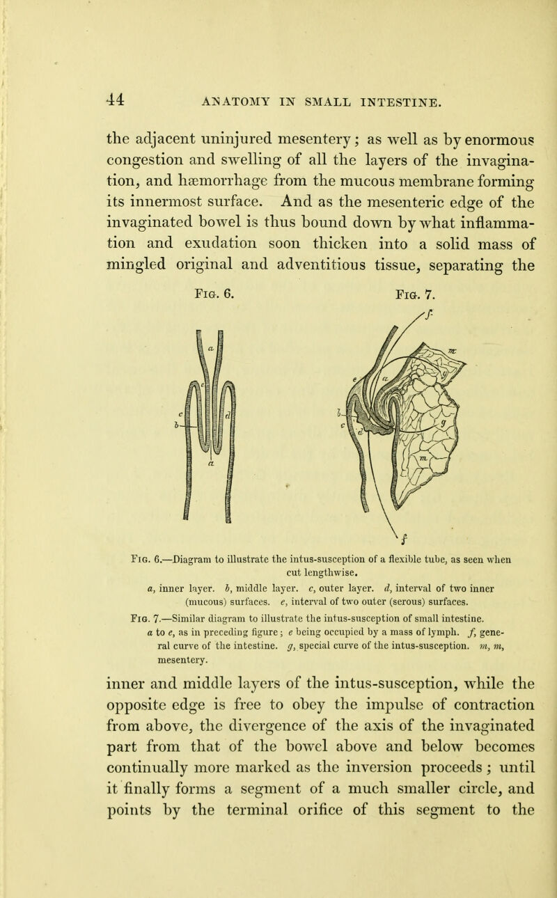 the adjacent uninjured mesentery; as well as by enormous congestion and swelling of all the layers of the invagina- tion, and haemorrhage from the mucous membrane forming its innermost surface. And as the mesenteric edge of the invaginated bowel is thus bound down by what inflamma- tion and exudation soon thicken into a solid mass of mingled original and adventitious tissue, separating the Fig. 6. Fig. 7. Fig. 6.—Diagram to illustrate the intus-susception of a flexible tube, as seen when cut lengthwise. a, inner layer, h, middle layer, c, outer layer, d, interval of two inner (mucous) surfaces, e, interval of two outer (serous) surfaces. Fig. 7.—Similar diagram to illustrate the intus-susception of small intestine. a to e, as in preceding figure ; e being occupied by a mass of lymph. /, gene- ral curve of the intestine. ^, special curve of the intus-susception. m, m, mesentery. inner and middle layers of the intus-susception, while the opposite edge is free to obey the impulse of contraction from above, the divergence of the axis of the invaginated part from that of the bowel above and below becomes continually more marked as the inversion proceeds; until it finally forms a segment of a much smaller circle, and points by the terminal orifice of this segment to the