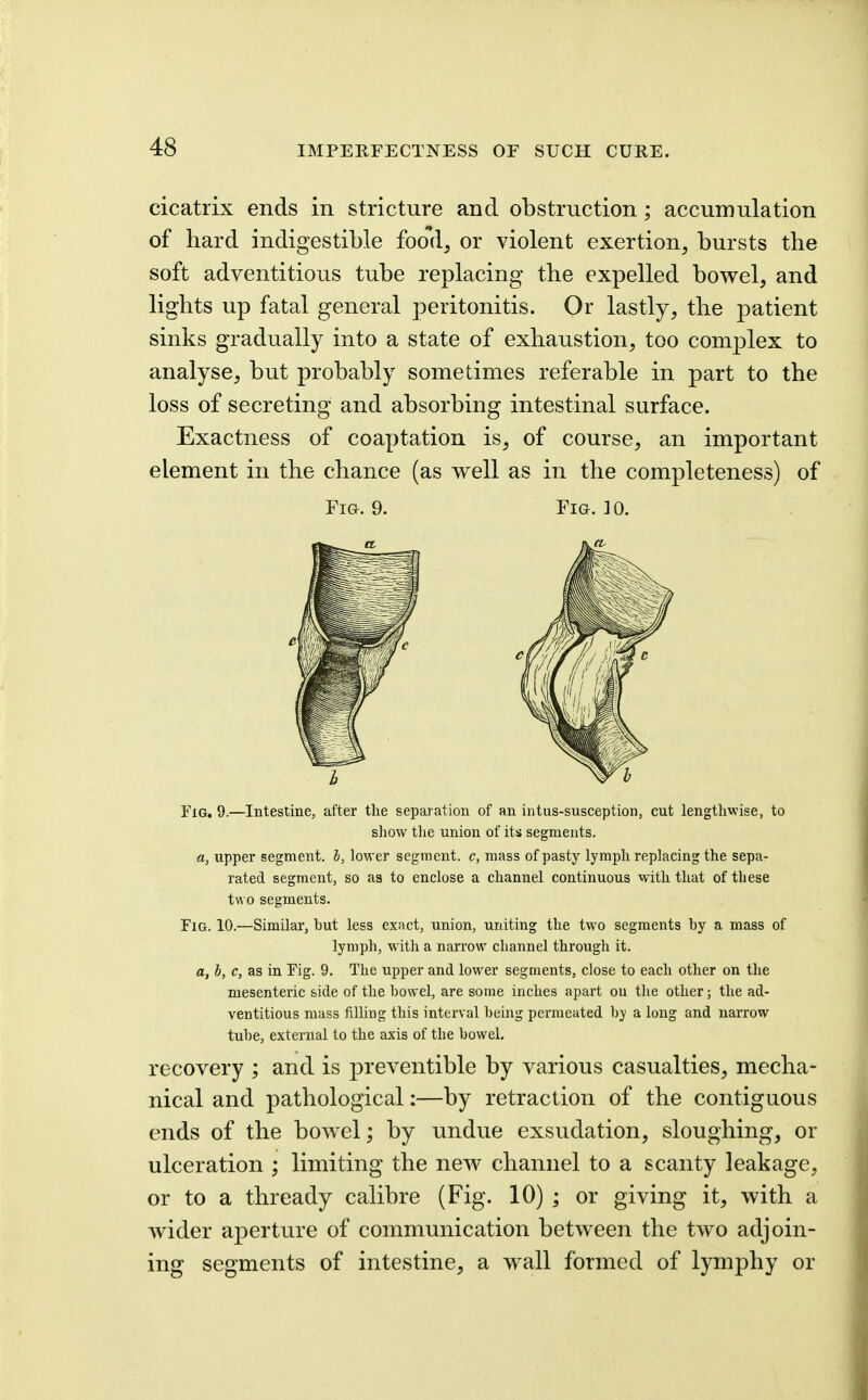 cicatrix ends in stricture and obstruction; accumulation of hard indigestible foo'd, or violent exertion, bursts the soft adventitious tube replacing the expelled bowel, and lights up fatal general peritonitis. Or lastly, the patient sinks gradually into a state of exhaustion, too complex to analyse, but probably sometimes referable in part to the loss of secreting and absorbing intestinal surface. Exactness of coaptation is, of course, an important element in the chance (as well as in the completeness) of Fig. 9. Fig. 30. Fig, 9.—Intestine, after the separation of an intus-susception, cut lengthwise, to show the union of its segments. a, upper segment, h, lower segment, c, mass of pasty lymph replacing the sepa- rated segment, so as to enclose a channel continuous with that of these two segments. Fig. 10.—Similar, but less exact, union, uniting the two segments by a mass of lymph, with a narrow channel through it. a, h, c, as in Fig. 9. The upper and lower segments, close to each other on the mesenteric side of the bowel, are some inches apart on the other; the ad- ventitious mass filling this interval being permeated by a long and narrow tube, external to the axis of the bowel. recovery ; and is preventible by various casualties, mecha- nical and pathological:—by retraction of the contiguous ends of the bowel; by undue exsudation, sloughing, or ulceration ; limiting the new channel to a scanty leakage, or to a thready calibre (Fig. 10) ; or giving it, with a wider ajDcrture of communication between the two adjoin- ing segments of intestine, a wall formed of lymphy or