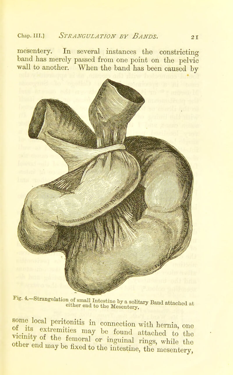 mesentery. In several instances the constricting band lias merely passed from one point on tlie pelvic ■wall to another. When the band has been caused by some local peritonitis in connection with hernia, one Xr P^.? , T''?^ °^ riiigs, while the other end may be tuced to the intestine, the mesentery,