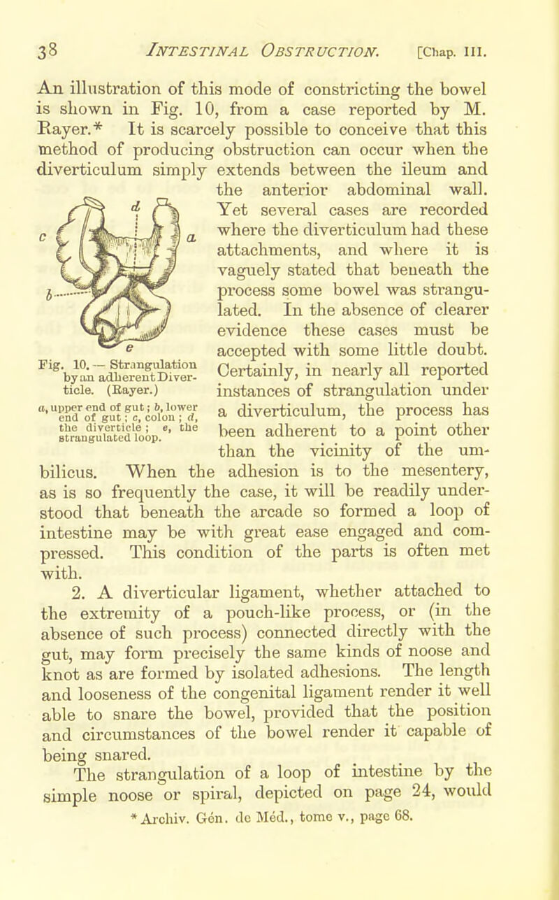 An illustration of this mode of constrictrag the bowel is shown in Fig. 10, from a case reported by M. Rayer.* It is scarcely possible to conceive that this method of producing obstruction can occur when the diverticulum simply extends between the ileum and the anterior abdominal wall. t'f r\ Yet several cases are recorded '\h % ^ where the diverticulum had these 'fWf 'I attachments, and where it is M vaguely stated that beneath the process some bowel was sti-angu- J^l lated. In the absence of clearer 'ji^ evidence these cases must be accepted with some little doubt. ^'V-'ateD^t Certainly, in nearly all reported tide. (Eayer.) instances of strangulation under •end'rf gSf?fio1on'!'d ^ diverticulum, the process has ^^ran^Xe^'iiip.'* '''' ^^^en adherent to a point other than the vicinity of the urn- bilicus. When the adhesion is to the mesentery, as is so frequently the case, it will be readily under- stood that beneath the arcade so formed a loop of intestine may be with great ease engaged and com- pressed. This condition of the parts is often met with. 2. A diverticular ligament, whether attached to the extremity of a pouch-like process, or (in the absence of such process) connected directly with the gut, may form precisely the same kinds of noose and knot as are formed by isolated adhesions. The length and looseness of the congenital ligament render it well able to snare the bowel, provided that the position and circumstances of the bowel render it capable of being snared. The strangulation of a loop of intestine by the simple noose or spiral, depicted on page 24, would * Aichiv. Gon. dc Med., tome v., page 68.