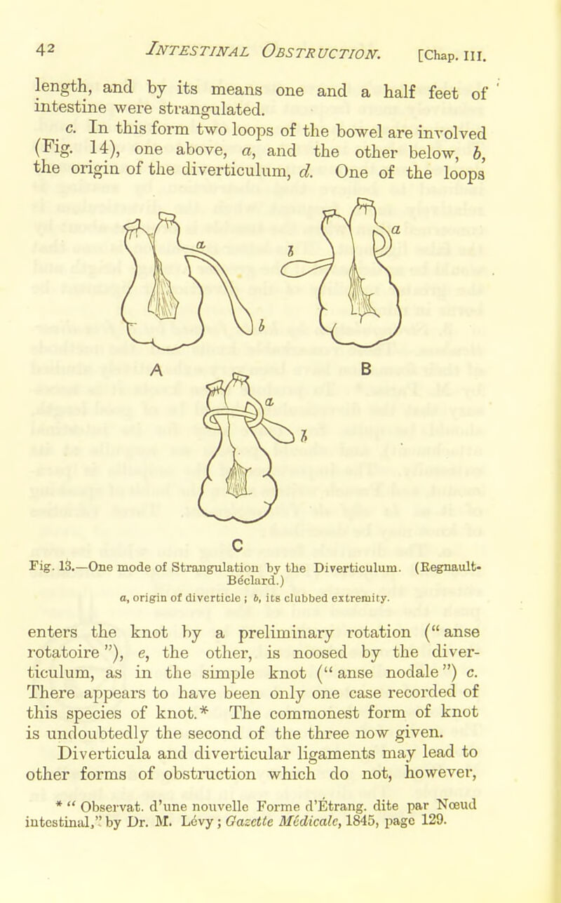 length, and by its means one and a half feet of intestine were strangulated. _ c. In this form two loops of the bowel are involved (Fig. 14), one above, a, and the other below, b, the origin of the diverticulum, d. One of the loops C Fig. IS.—One mode of Strangulation by the Diverticulum. (Eegnault- Bdclard.) a, origin of diverticle ; 6, its clubbed extremity. enters the knot by a preliminary rotation ( anse r'otatoire), e, the other, is noosed by the diver- ticulum, as in the simple knot ( anse nodale) c. There appears to have been only one case recorded of this species of knot.* The commonest form of knot is undoubtedly the second of the three now given. Diverticula and diverticular ligaments may lead to other forms of obstruction which do not, however, * Observat. d'une nouvelle Forme d'Etrang. dite par Noeud iutestiniilj'' by Dr. M. Levy; Gazette Medicale, 1845, page 129.