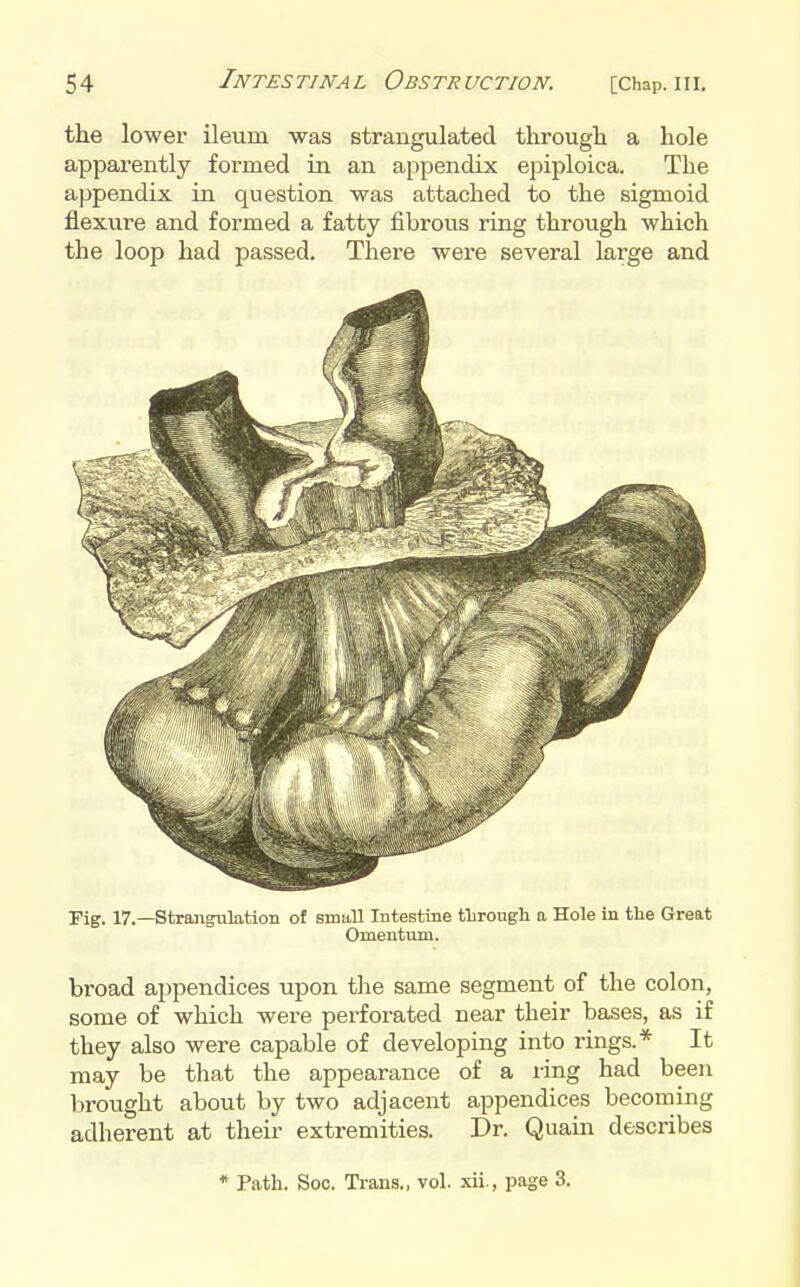 the lower ileum was strangulated through a hole apparently formed in an appendix epiploica. The appendix in question was attached to the sigmoid flexure and formed a fatty fibrous ring through which the loop had passed. There were several large and Fig. 17.—strangulation of small Intestine tlirougli a Hole in the Great Omentum. broad appendices upon the same segment of the colon, some of which were perforated near their bases, as if they also were capable of developing into rings.* It may be that the appearance of a i-ing had been brought about by two adjacent appendices becoming adherent at their extremities. Dr. Quain describes * Path. Soo. Traus., vol. xii., page 3.