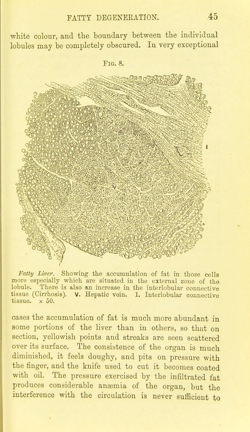 white colour, and the boundary between the individual lobules may be completely obscured. In very exceptional Fig. 8. Fatty Liver. Showing the accumulation of fat in those cells more especially which are situated in the external zone of the lobule. There is also an increase in the interlobular connective tissue (Cirrhosis). V. Hepatic vein. 1. Interlobular connective tissue. X 50. cases the accumulation of fat is much more abundant in some portions of the liver than in others, so that on section, yellowish points and streaks are seen scattered over its surface. The consistence of the organ is much diminished, it feels doughy, and pits on pressure with the finger, and the knife used to cut it becomes coated with oil. The pressure exercised by the infiltrated fat produces considerable anaemia of the organ, but the interference with the circulation is never sufficient to