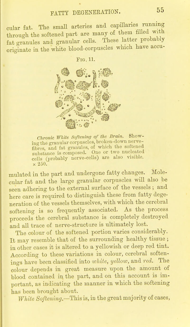 cular fat. The smaU arteries and capillaries running through the softened part are many of them filled with fat crannies and granular cells. These latter probably orio-inate in the white blood-corpuscles which have accu- Fig. 11. Chronic White Softening of the Brain. Show- ino- the granular corpuscles, broken-down nerve- fibi-es and fat granules, of which the softened substance is composed. One or two nucleated cells (probably nerve-cells) are also visible. X 250. mulated in the part and undergone fatty changes. Mole- cular fat and the large granular corpuscles will also be seen adhering to the external surface of the vessels ; and here care is required to distinguish these from fatty dege- neration of the vessels themselves, with which the cerebral softening is so frequently associated. As the process proceeds the cerebral substance is completely destroyed and aU trace of nerve-structure is ultimately lost. The colour of the softened portion varies considerably. It may resemble that of the surrounding healthy tissue ; in other cases it is altered to a yellowish or deep red tint. According to these variations in colour, cerebral soften- ings have been classified into while, yellow, and red. The colour depends in great measure upon the amount of blood contained in the part, and on this account is im- portant, as indicating the manner in which the softening has been brought about. White Softening.—This is, in the great majority of cases.
