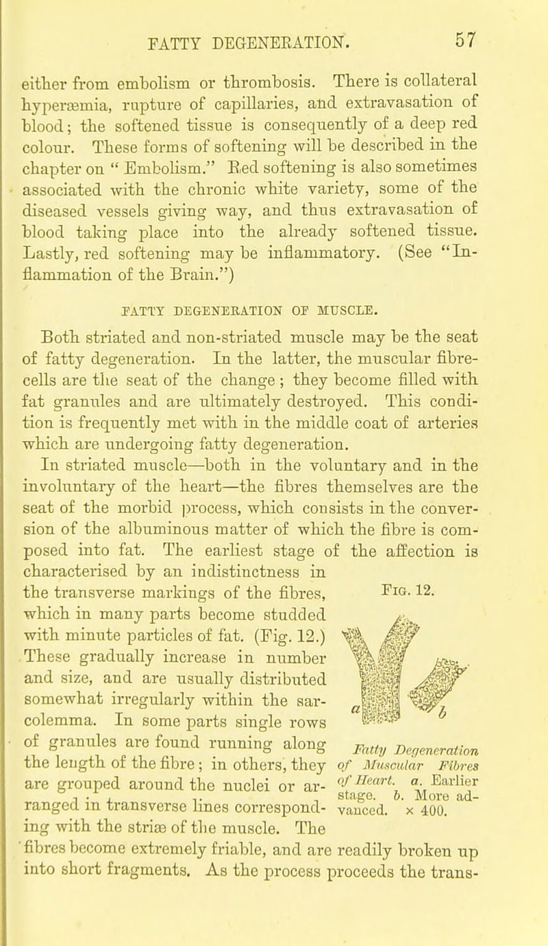 either from embolism or thrombosis. There is collateral hyperemia, rupture of capillaries, and extravasation of blood; the softened tissue is consequently of a deep red colour. These forms of softening will be described in the chapter on  Embolism. B,ed softening is also sometimes associated with the chronic white variety, some of the diseased vessels giving way, and thus extravasation of blood taking place into the already softened tissue. Lastly, red softening maybe inflammatory. (See In- flammation of the Brain.) PATTY DEGENEEATION OE MUSCLE. Both striated and non-striated muscle may be the seat of fatty degeneration. In the latter, the muscular fibre- cells are the seat of the change ; they become filled with fat granules and are ultimately destroyed. This condi- tion is frequently met with in the middle coat of arteries which are undergoing fatty degeneration. In striated muscle—both in the voluntary and in the involuntary of the heart—the fibres themselves are the seat of the morbid |)rocess, which consists in the conver- sion of the albuminous matter of which the fibre is com- posed into fat. The earliest stage of the afi;ection is characterised by an indistinctness in the transverse markings of the fibres, ^i^-12. which in many parts become studded with minute particles of fat. (Fig. 12.) These gradually increase in number and size, and are usually distributed somewhat irregularly within the aar- colemma. In some parts single rows of granules are found running along -p^^^^y Deg^eration the length of the fibre ; in others, they of Muscular Fibres are grouped around the nuclei or ar- 'ifa- Earlier T . , , stage. 6. More ad- tanged m transverse Imes correspond- vauced. x 400. ing with the strise of the muscle. The ■fibresbecome extremely friable, and are readily broken up into short fragments. As the process proceeds the trans-