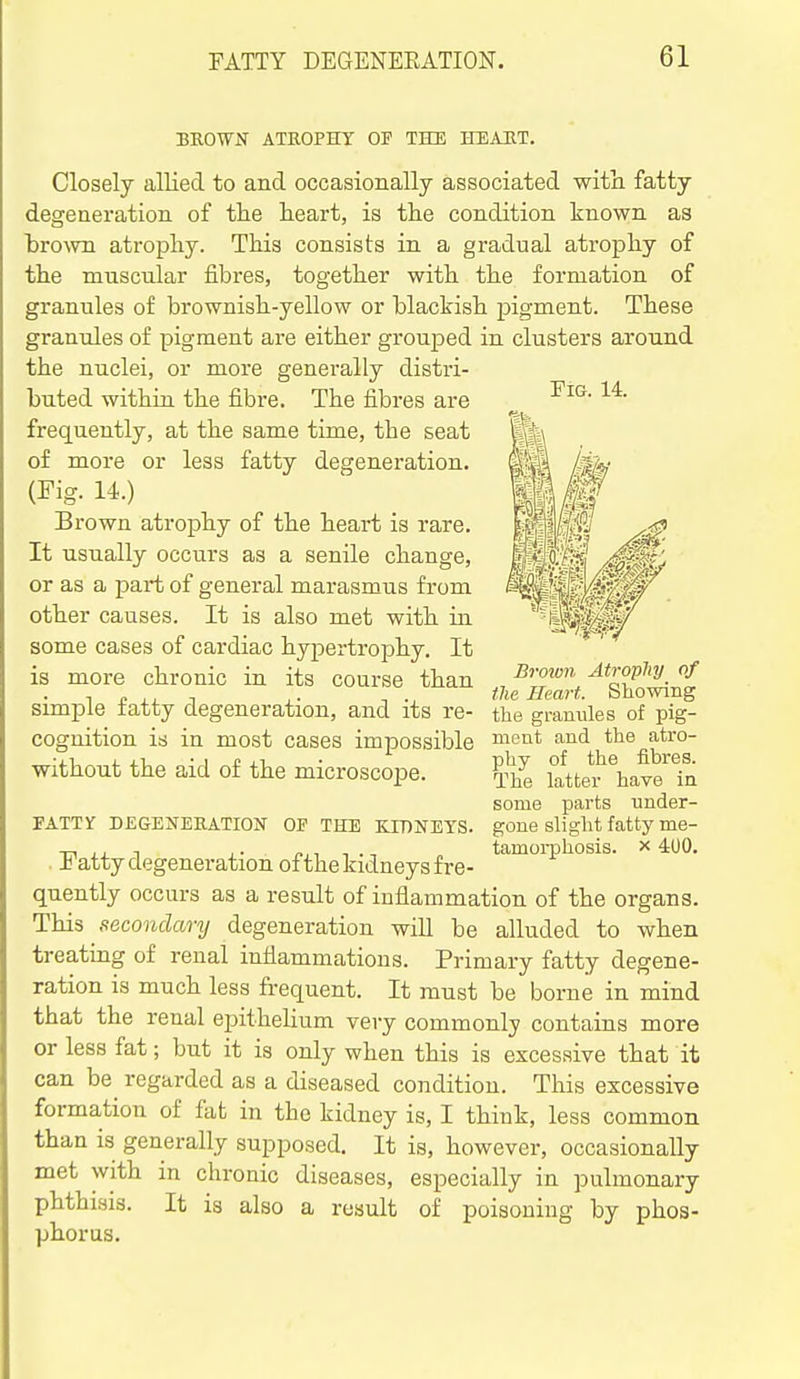 BROWN ATROPHY OF THE KEAET. Closely allied to and occasionally associated with fatty degeneration of tlie heart, is the condition known as bro^vn ati-ophy. This consists in a gradual atrophy of the muscnlar fibres, together with the formation of granules of brownish-yellow or blackish pigment. These granules of pigment are either grouped in clusters around the nuclei, or more generally distri- buted within the fibre. The fibres are frequently, at the same time, the seat of more or less fatty degeneration. (Fig. 14.) Brown atrophy of the heart is rare. It usually occurs as a senile change, or as a part of general marasmus from other causes. It is also met with in some cases of cardiac hypertrophy. It is more chronic in its course than simple fatty degeneration, and its re- cognition is in most cases impossible without the aid of the microscope. FATTY DEGENERATION OP THE KJDNETS. Fatty degeneration ofthe kidneys fre- quently occurs as a result of inflammation of the organs. This secondary degeneration will be alluded to when treatmg of renal inflammations. Primary fatty degene- ration is much less frequent. It must be borne in mind that the renal epithelium very commonly contains more or less fat; but it is only when this is excessive that it can be^ regarded as a diseased condition. This excessive formation of fat in the kidney is, I think, less common than is generally supposed. It is, however, occasionally met with in chronic diseases, especially in pulmonary phthisis. It is also a result of poisoning by phos- phorus. Fig. 14. Eroivn Atrophy of the Heart. Showing the granules of pig- ment and the atro- phy of the fibres. The latter have ia some parts under- gone slight fatty me- tamorphosis. X 4(J0.