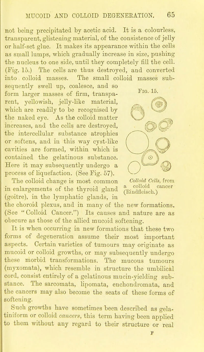 not being precipitated by acetic acid. It is a colourless, transparent, glistening material, of the consistence of jelly or half-set glue. It mates its appearance within the cells as small lumps, which gradually increase in size, pushing the nucleus to one side, until they completely fill the cell. (Fig. 16.) The cells are thus destroyed, and converted into colloid masses. The small colloid masses sub- sequently swell up, coalesce, and so form larger masses of firm, transpa- rent, yellowish, jelly-like material, which are readily to be recognised by the naked eye. As the colloid matter increases, and the cells are destroyed, the intercellular substance atrophies or softens, and in this way cyst-like cavities are formed, within which is contained the gelatinous substance. Here it may subsequently undei'go a process of liquefaction. (See Fig. 67). The colloid change is most common in enlai'gements of the thyroid gland (goitre), in the lymphatic glands, in the choroid plexus, and in many of the new formations. (See  Colloid Cancer.) Its causes and nature are as obscui-e as those of the allied mucoid softening. It is when occurring in new formations that these two forms of degeneration assume their most important aspects. Cei-tain varieties of tumours may originate as mucoid or colloid growths, or may subsequently undergo these morbid transformations. The mucous tumours (myxomata), which resemble in structure the umbilical cord, consist entirely of a gelatinous mucin-yielding sub- stance. The sarcomata, lipomata, enchondromata, and the cancers may also become the seats of these forms of softening. Such growths have sometimes been described as gela- tin i form or colloid cancers, this term having been applied to them without any regard to their structure or real Colloid Cells, from a colloid cancer (Eiudfleisch.)