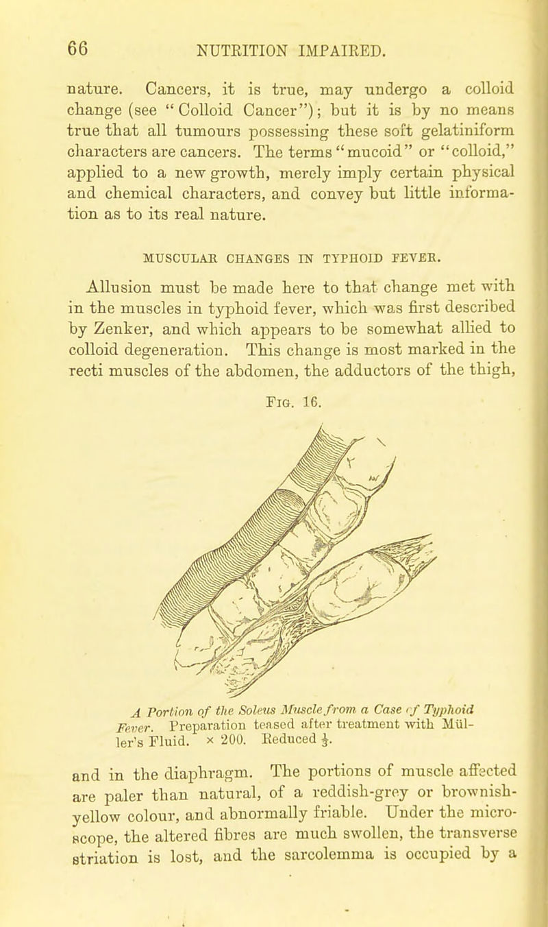 nature. Cancers, it is true, may undergo a colloid change (see Colloid Cancer); but it is by no means true that all tumours possessing these soft gelatiniform characters are cancers. The terms mucoid or colloid, applied to a new growth, merely imply certain physical and chemical characters, and convey but little informa- tion as to its real nature. MUSCULAR CHANGES IN TYPHOID PEVEB. Allusion must be made here to that change met with in the muscles in typhoid fever, which was first described by Zenker, and which appears to be somewhat allied to colloid degeneration. This change is most marked in the recti muscles of the abdomen, the adductors of the thigh, Fig. 16. A Portion of the Salens Mmclefrom a Case <-/ Typhoid Fe.ver. Preparation teased after treatment with Mai- ler's Fluid. X 200. Reduced J. and in the diaphragm. The portions of muscle affected are paler than natural, of a reddish-grey or brownish- yellow colour, and abnormally friable. Under the niicro- Bcope, the altered fibres are much swollen, the transverse striation is lost, and the sarcolemma is occupied by a