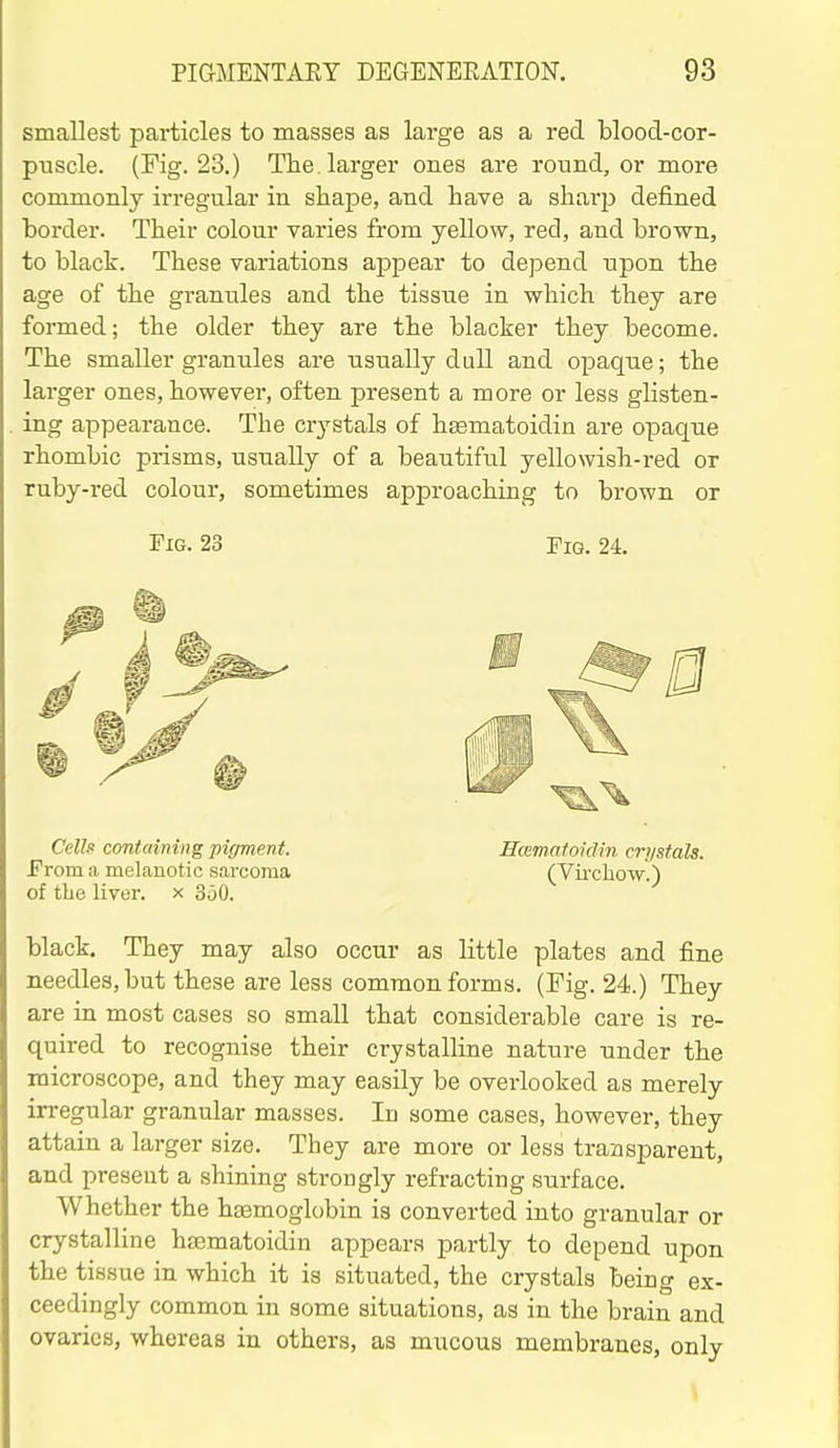 smallest particles to masses as large as a red blood-cor- puscle. (Fig. 23.) The larger ones are round, or more commonly irregular in shape, and have a sharp defined horder. Their colour varies from yellow, red, and brown, to black. These variations appear to depend upon the age of the granules and the tissue in which they are formed; the older they are the blacker they become. The smaller granules are usually dull and opaque; the larger ones, however, often present a more or less glisten- ing appearance. The crystals of hEematoidin are opaque rhombic prisms, usually of a beautiful yellowish-red or ruby-red colour, sometimes approaching to brown or Fig. 23 Fig. 24. CeUa containing pigment. Hcematoidin crystals. From a melanotic sarcoma (Vii'cliow.) of the liver, x 350. black. They may also occur as little plates and fine needles, but these are less common forms. (Fig. 24.) They are in most cases so small that considerable care is re- quired to recognise their crystalline nature under the microscope, and they may easily be overlooked as merely irregular granular masses. Id some cases, however, they attain a larger size. They are more or less transparent, and present a shining strongly refracting surface. Whether the hfemoglobin is converted into granular or crystalline hajmatoidin appears partly to depend upon the tissue in which it is situated, the crystals being ex- ceedingly common in some situations, as in the brain and ovaries, whereas in others, as mucous membranes, only