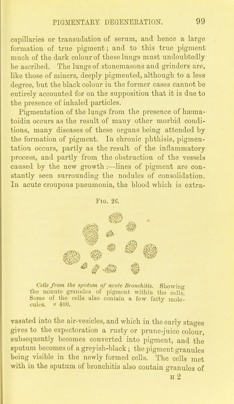 capillavies or transudation of serum, and hence a large formation of true pigment; and to this true j)igment much of the dark colour of these lungs must undoubtedly be ascribed. The lungs of stonemasons and grinders are, like those of miners, deeply pigmented, although to a less degree, but the black colour in the former cases cannot be entirely accounted for on the supposition that it is due to the presence of inhaled particles. Pigmentation of the lungs from the presence of hsema- toidin occurs as the result of many other morbid condi- tions, many diseases of these organs being attended by the formation of pigment. In chronic johthisis, pigmen- tation occurs, partly as the result of the inflammatoiy process, and partly from the obstruction of the vessels caused by the new growth :—lines of pigment are con- stantly seen surrounding the nodules of consolidation. In acute croupous pneumonia, the blood which is extra- FiG. 26. CeUs from the spntum of acute Bronchitis. Showing the minute granules of pigment within the cells. Some of the cells also contain a few fatty mole- cules. X 400. vaaated into the air-vesicles, and which in the early stages gives to the expectoration a rusty or prune-juice colour, subsequently becomes converted into pigment, and the sputum becomes of a greyish-black; the pigment granules being visible in the newly formed cells. The cells met with in the sputum of bronchitis also contain granules of u2