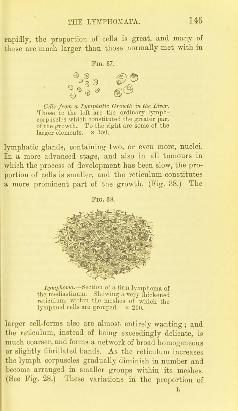 rapidly, the proportion of cells is great, and many of these are mucli larger than those normally met with in Fig. 37. 'D ^ Cells from a Lymphatic Groioth in the Liver. Those to the left are the ordinary lymph- corpuscles which constituted the greater part of the growth. To the right are some of the larger elements, x 350. lymphatic glands, containing two, or even more, nuclei. In a more advanced stage, and also in all tumours in which, tlie process of development has been slow, th.e pro- portion of cells is smaller, and the reticulum constitutes a more prominent part of the growth. (Fig. 38.) The Fig. 38. Lymphoma.—Section of a firm lymphoma of the mediastiuiim. Showing a very thickened reticulum, within the meshes of which the lymphoid cells are grouped, x 200. larger cell-forms also are almost entirely wanting; and the reticulum, instead of being exceedingly delicate, is much coarser, and forms a network of broad homogeneous or slightly fibrillated bands. As the reticulum increases the lymph corpuscles gradually diminish in number and become arranged in smaller groups within its meshes. (See Fig. 28.) These variations in the proportion of L