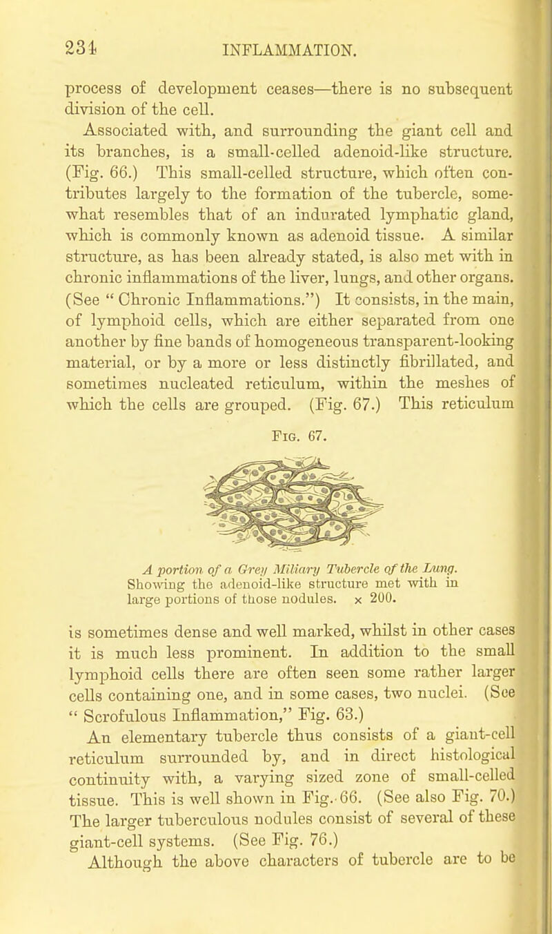 process of development ceases—there is no subsequent division of the cell. Associated with, and surrounding the giant cell and its branches, is a small-celled adenoid-like structure. (Fig. 66.) This small-celled structure, which often con- tributes largely to the formation of the tubercle, some- what resembles that of an indurated lymphatic gland, which is commonly known as adenoid tissue. A similar structure, as has been already stated, is also met with in chronic inflammations of the liver, lungs, and other organs. (See  Chronic Inflammations.) It consists, in the main, of lymphoid cells, which are either separated from one another by fine bands of homogeneous transparent-looking material, or by a more or less distinctly fibrillated, and sometimes nucleated reticulum, within the meshes of which the cells are grouped. (Fig. 67.) This reticulum Fig. 67. A portion of a Gre)/ Miliary Tubercle qfthe Lung. Showing the adenoid-like structure met with La large jiortions of ttiose nodules, x 200. is sometimes dense and weU marked, whilst in other cases it is much less prominent. In addition to the small lymphoid cells there are often seen some rather larger cells containing one, and in some cases, two nuclei. (See  Scrofulous Inflammation, Fig. 63.) An elementary tubercle thus consists of a giant-cell reticulum surrounded by, and in direct histological continuity with, a varying sized zone of small-celled tissue. This is well shown in Fig.-66. (See also Fig. 70.) The larger tuberculous nodules consist of several of these giant-cell systems. (See Fig. 76.) Although the above characters of tubercle are to be