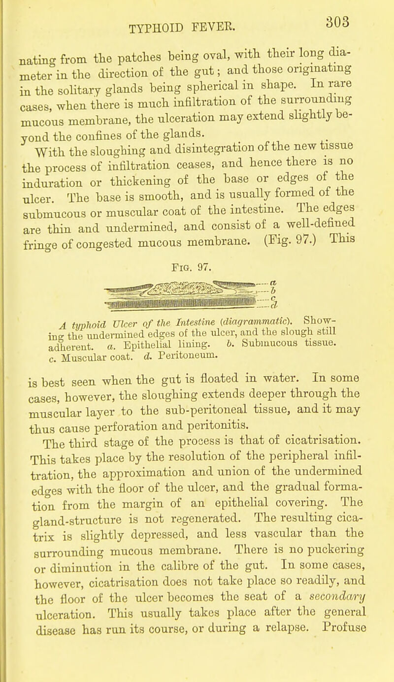 natm<^ from tlie patches being oval, with their long dia- meter in the direction of the gut; and those originating in the soHtary glands being spherical in shape. In rare cases, when there is much infiltration of the surrounding mucous membrane, the ulceration may extend slightly be- yond the confines of the glands. With the sloughing and disintegration of the new tissue the process of infiltration ceases, and hence there is no induration or thickening of the base or edges of the ulcer. The base is smooth, and is usually formed of the submucous or muscular coat of the intestine. The edges are thin and undermined, and consist of a well-defined fringe of congested mucous membrane. (Fig. 97.) This Fig. 97. A ttjphoid Ulcer of the Intestine {diagrammatic). Show- ine: the undermined edges of the ulcer, and the slough still adherent, a. Epithelial lining. b. Submucous tissue, c. Muscular coat. d. Peritoneum. is best seen when the gut is floated in water. In some cases, however, the sloughing extends deeper through the muscular layer to the sub-peritoneal tissue, and it may thus cause perforation and peritonitis. The third stage of the process is that of cicatrisation. This takes place by the resolution of the peripheral infil- tration, the approximation and union of the undermined edo'es with the floor of the ulcer, and the gradual forma- tion from the margin of an epithelial covering. The gland-structure is not regenerated. The resulting cica- trix is slightly depressed, and less vascular than the surrounding mucous membrane. There is no puckering or diminution in the calibre of the gut. In some cases, however, cicatrisation does not take place so readily, and the floor of the ulcer becomes the seat of a secondary ulceration. This usually takes place after the general disease has run its course, or during a relapse. Profuse